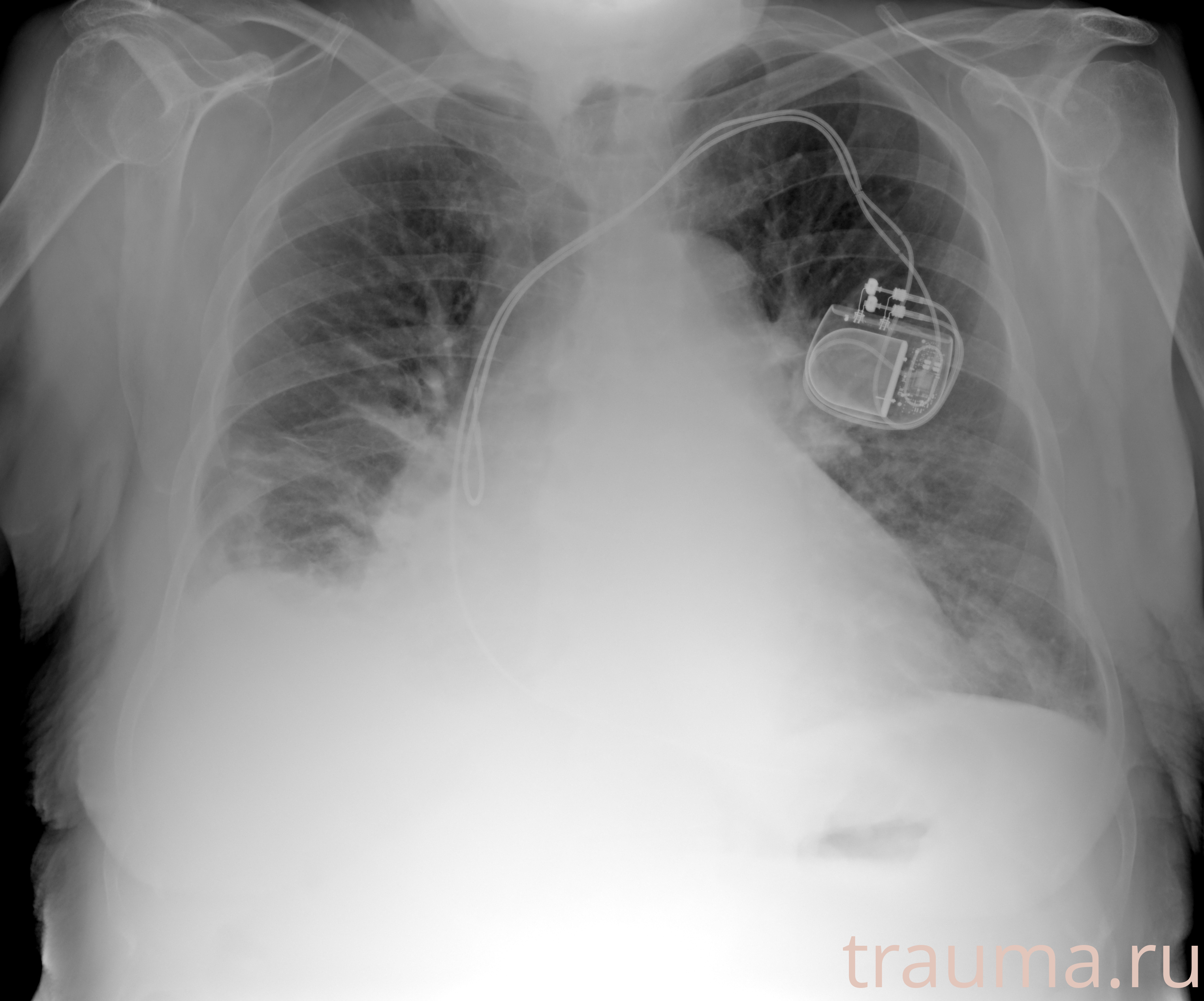 Рентген на дому: по вашему адресу приезжает врач-рентгенолог, травматолог-ортопед с мобильным рентгеновским аппаратом, проводит диагностику травмы или заболевания, делает необходимые рентгенограммы, дает рекомендации по дальнейшему лечению. Получить качественные снимки в домашних условиях возможно благодаря уникальной методике, разработанной МосРентген Центром для института  Склифосовского