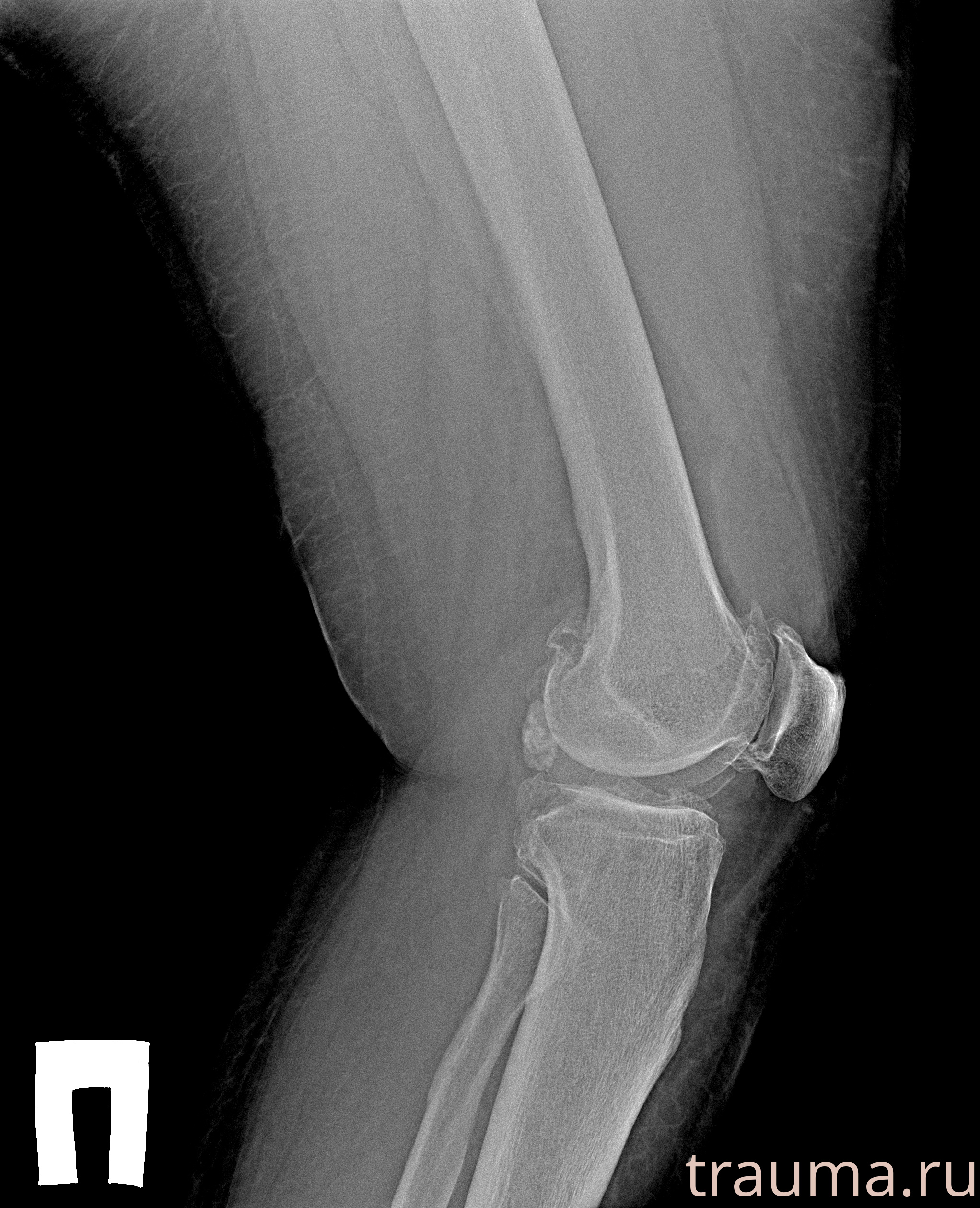 Рентген на дому: по вашему адресу приезжает врач-рентгенолог, травматолог-ортопед с мобильным рентгеновским аппаратом, проводит диагностику травмы или заболевания, делает необходимые рентгенограммы, дает рекомендации по дальнейшему лечению. Получить качественные снимки в домашних условиях возможно благодаря уникальной методике, разработанной МосРентген Центром для института  Склифосовского