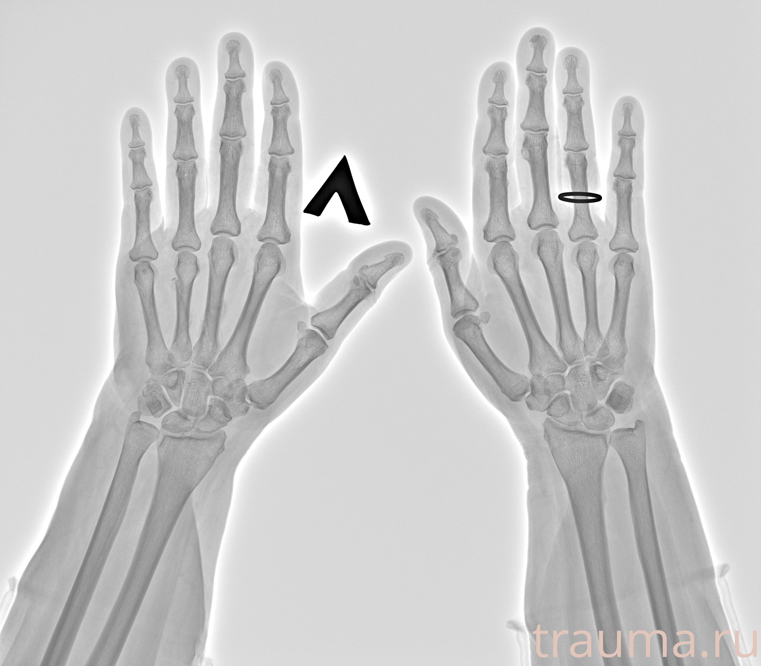 Рентген на дому: по вашему адресу приезжает врач-рентгенолог, травматолог-ортопед с мобильным рентгеновским аппаратом, проводит диагностику травмы или заболевания, делает необходимые рентгенограммы, дает рекомендации по дальнейшему лечению. Получить качественные снимки в домашних условиях возможно благодаря уникальной методике, разработанной МосРентген Центром для института  Склифосовского