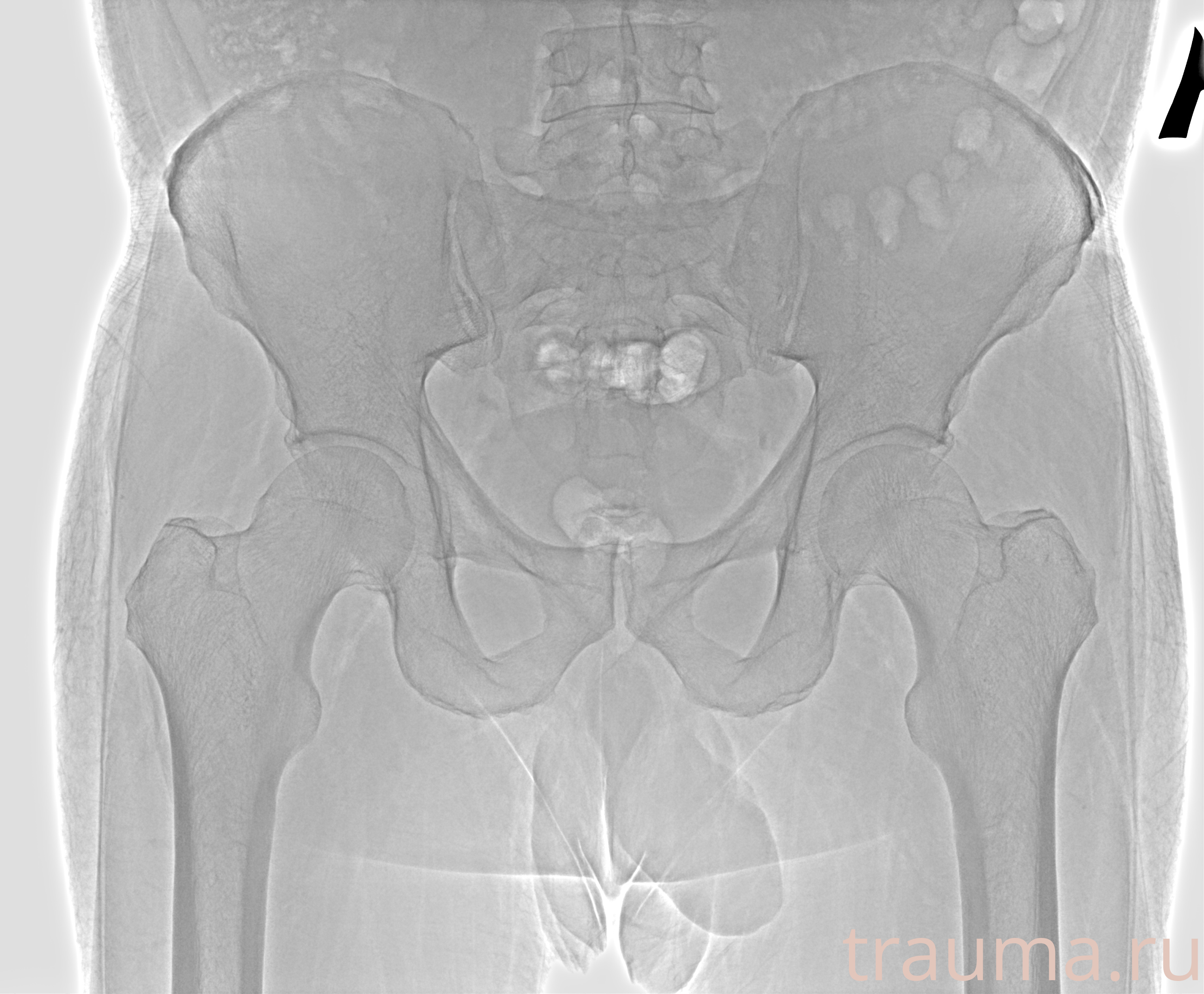 Рентген на дому: по вашему адресу приезжает врач-рентгенолог, травматолог-ортопед с мобильным рентгеновским аппаратом, проводит диагностику травмы или заболевания, делает необходимые рентгенограммы, дает рекомендации по дальнейшему лечению. Получить качественные снимки в домашних условиях возможно благодаря уникальной методике, разработанной МосРентген Центром для института  Склифосовского