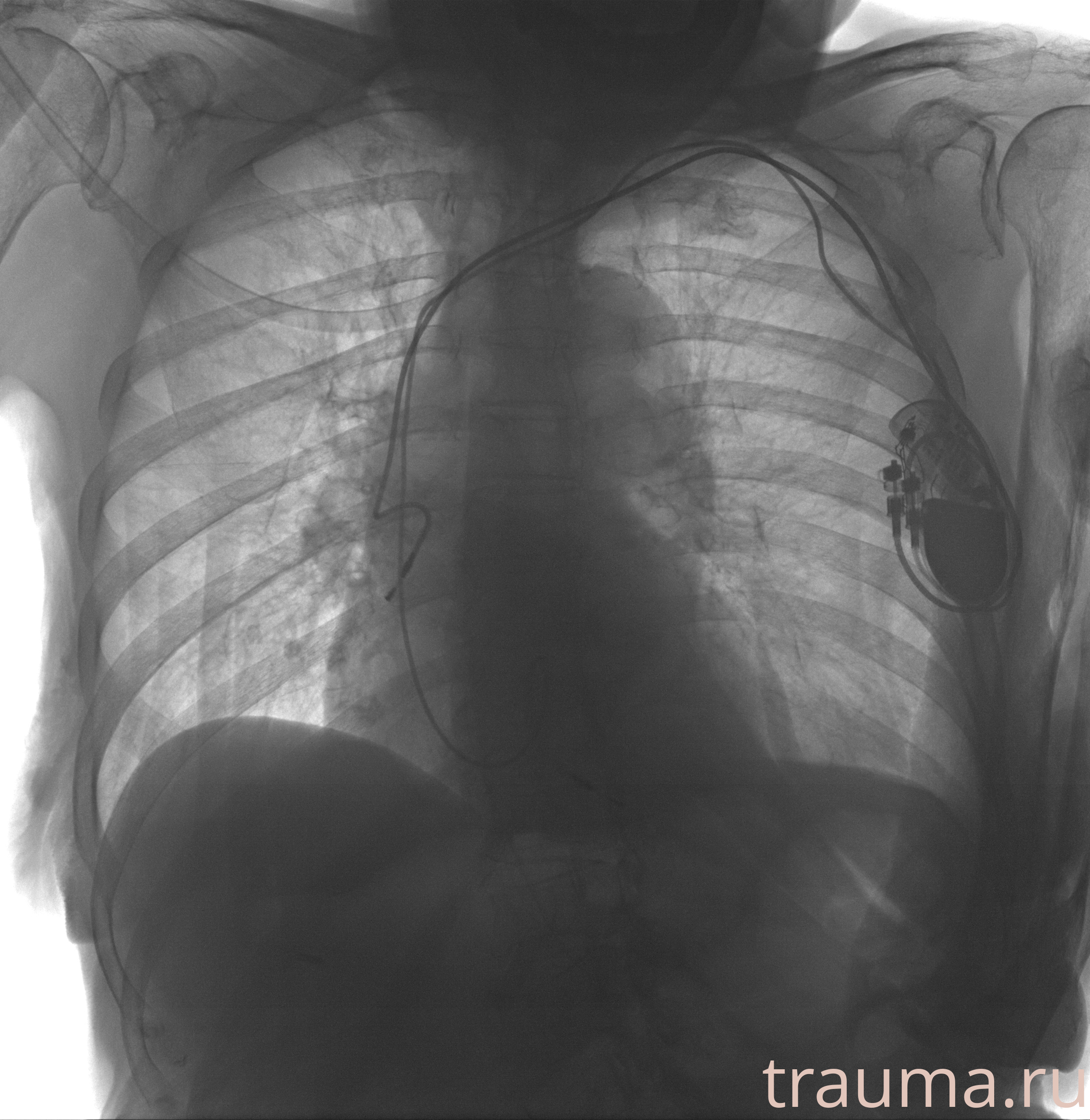 Рентген на дому: по вашему адресу приезжает врач-рентгенолог, травматолог-ортопед с мобильным рентгеновским аппаратом, проводит диагностику травмы или заболевания, делает необходимые рентгенограммы, дает рекомендации по дальнейшему лечению. Получить качественные снимки в домашних условиях возможно благодаря уникальной методике, разработанной МосРентген Центром для института  Склифосовского