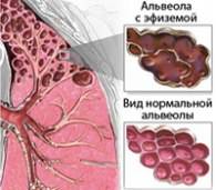 Эмфизема легких Эмфизема легких