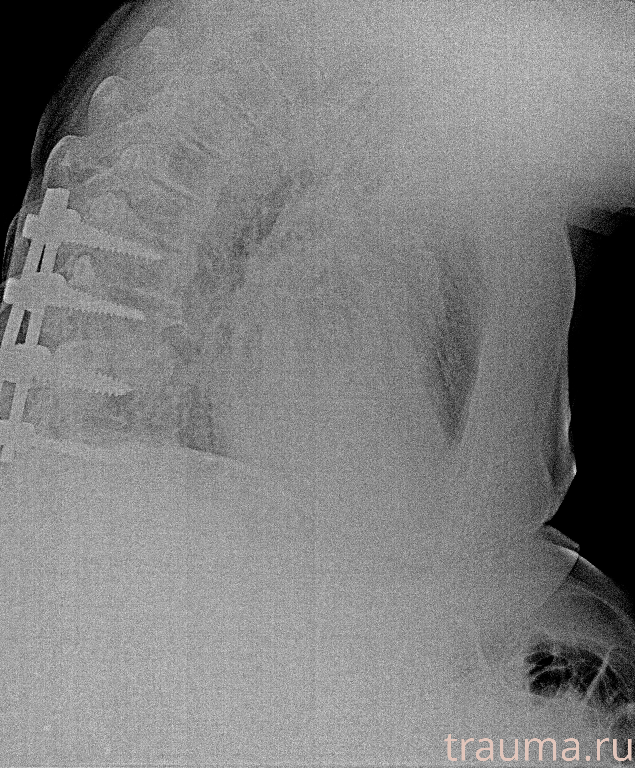 Рентген на дому: по вашему адресу приезжает врач-рентгенолог, травматолог-ортопед с мобильным рентгеновским аппаратом, проводит диагностику травмы или заболевания, делает необходимые рентгенограммы, дает рекомендации по дальнейшему лечению. Получить качественные снимки в домашних условиях возможно благодаря уникальной методике, разработанной МосРентген Центром для института  Склифосовского