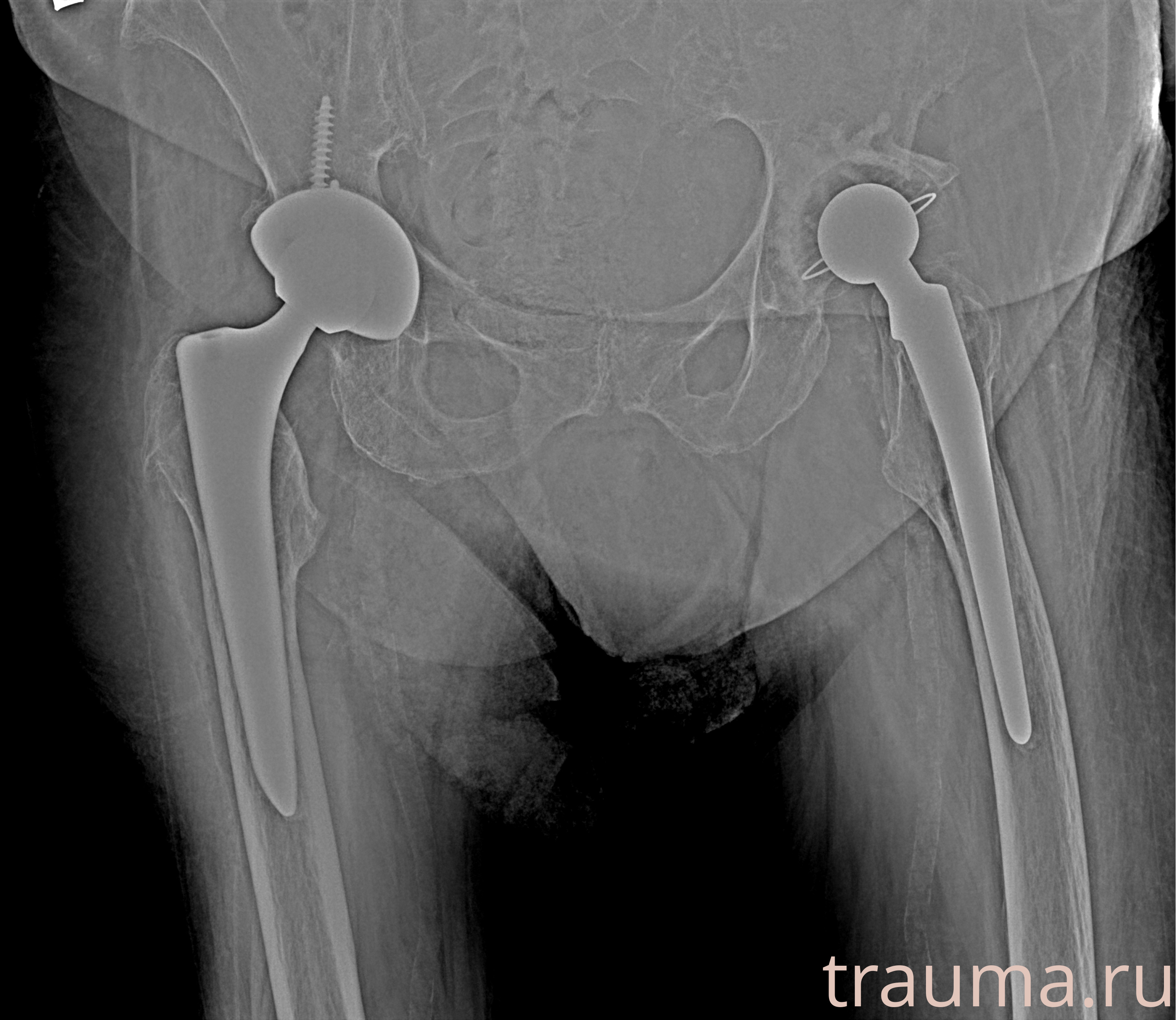 Рентген на дому: по вашему адресу приезжает врач-рентгенолог, травматолог-ортопед с мобильным рентгеновским аппаратом, проводит диагностику травмы или заболевания, делает необходимые рентгенограммы, дает рекомендации по дальнейшему лечению. Получить качественные снимки в домашних условиях возможно благодаря уникальной методике, разработанной МосРентген Центром для института  Склифосовского