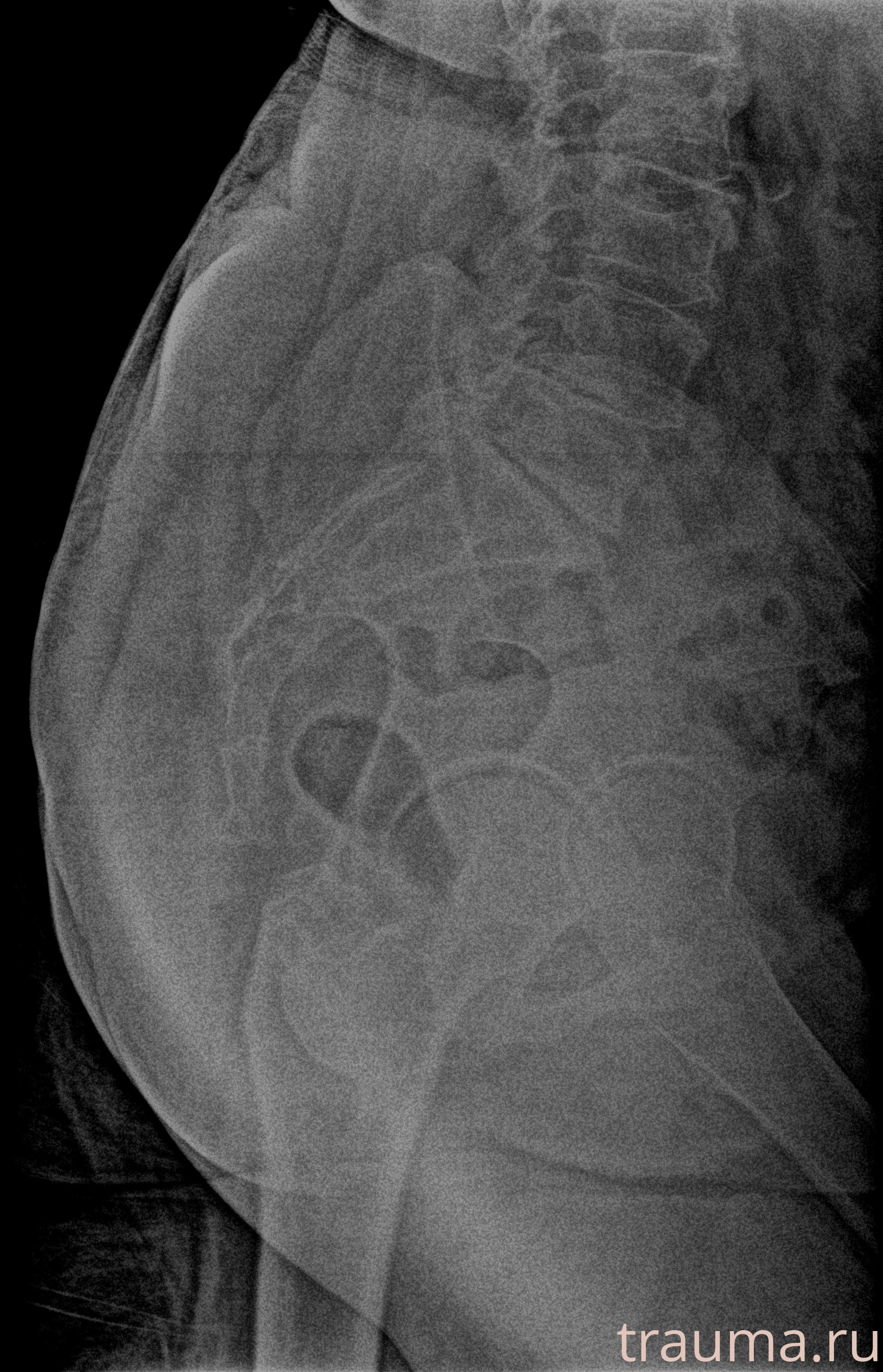 Рентген на дому: по вашему адресу приезжает врач-рентгенолог, травматолог-ортопед с мобильным рентгеновским аппаратом, проводит диагностику травмы или заболевания, делает необходимые рентгенограммы, дает рекомендации по дальнейшему лечению. Получить качественные снимки в домашних условиях возможно благодаря уникальной методике, разработанной МосРентген Центром для института  Склифосовского