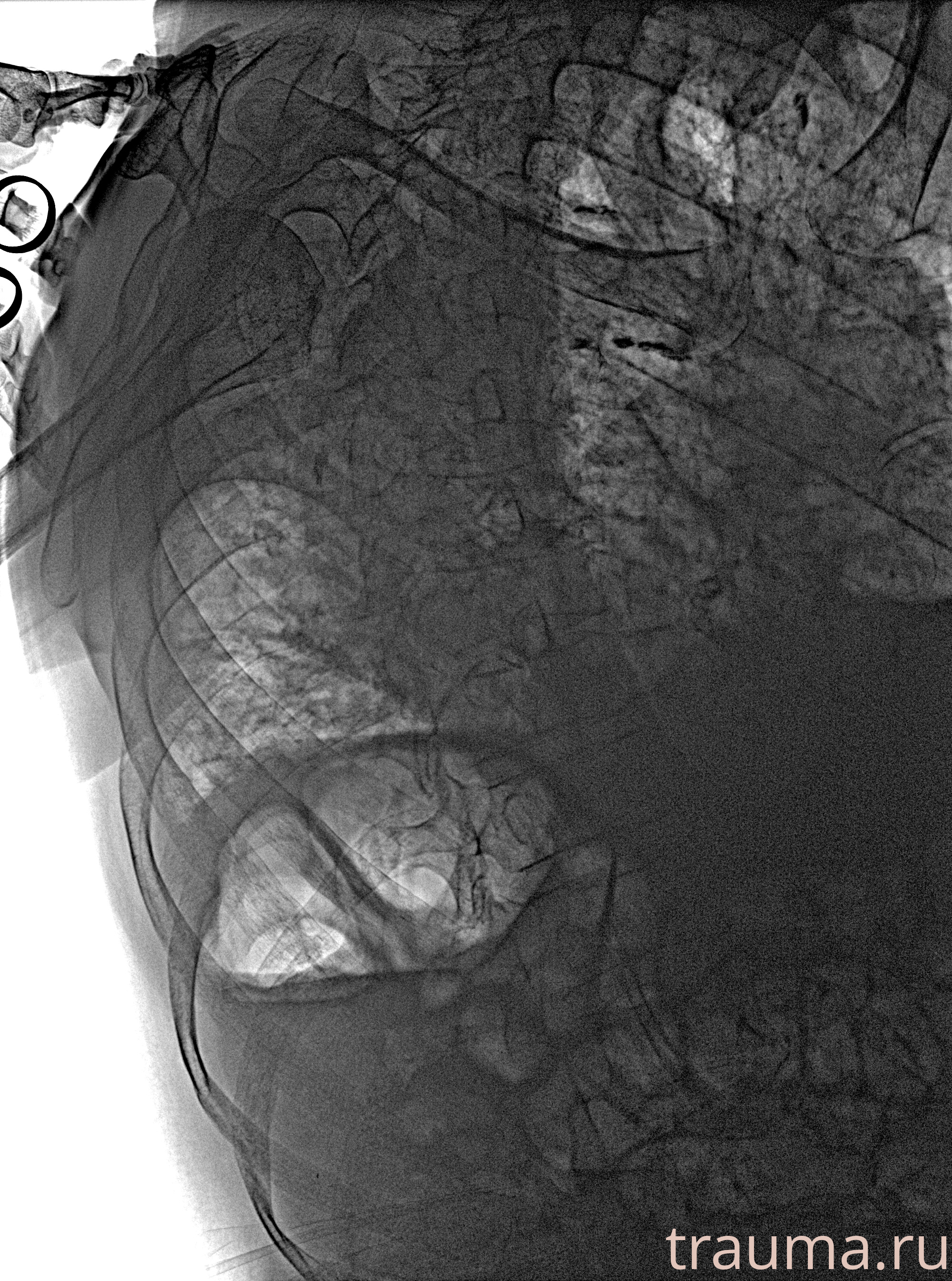 Рентген на дому: по вашему адресу приезжает врач-рентгенолог, травматолог-ортопед с мобильным рентгеновским аппаратом, проводит диагностику травмы или заболевания, делает необходимые рентгенограммы, дает рекомендации по дальнейшему лечению. Получить качественные снимки в домашних условиях возможно благодаря уникальной методике, разработанной МосРентген Центром для института  Склифосовского