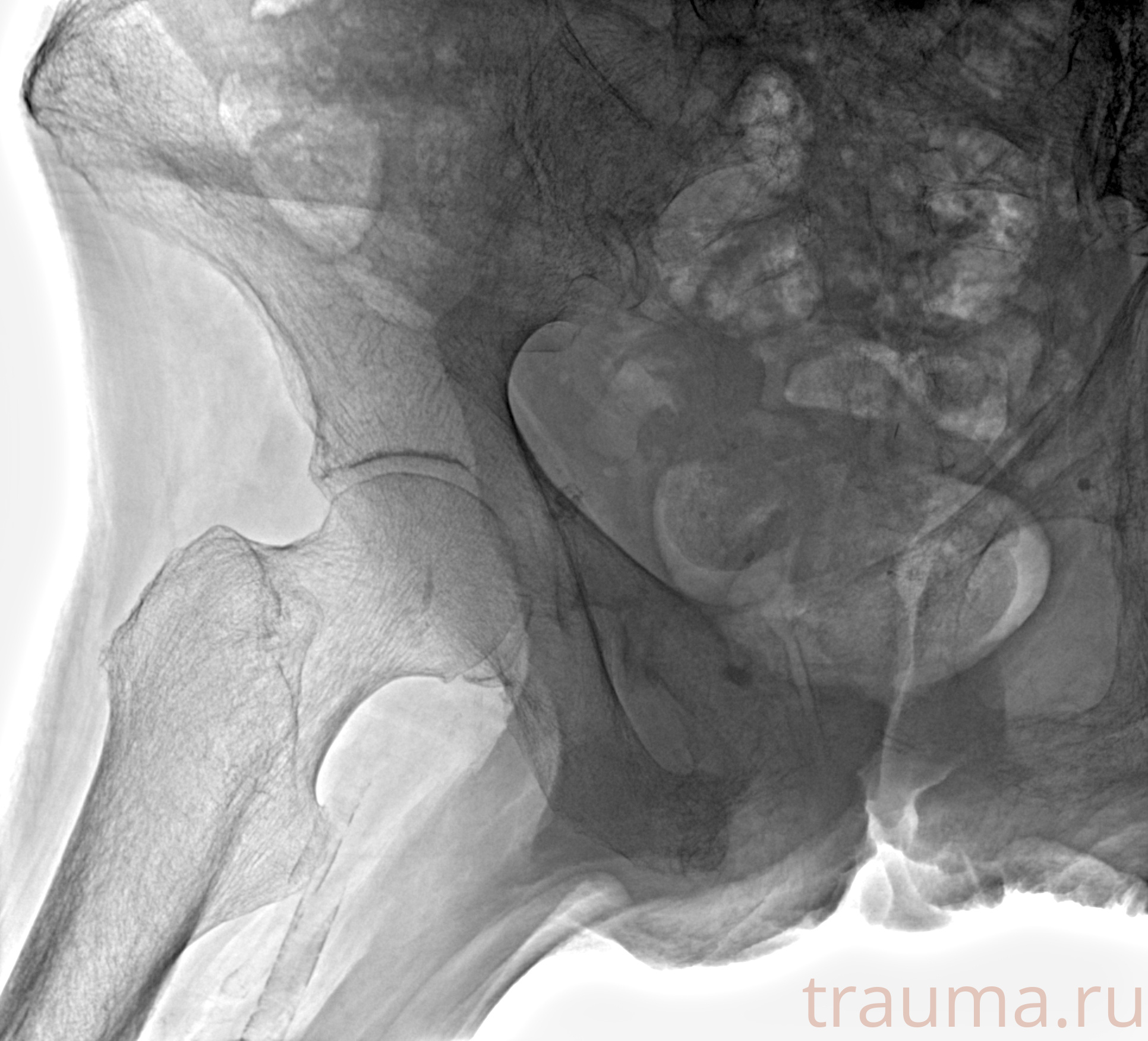 Рентген на дому: по вашему адресу приезжает врач-рентгенолог, травматолог-ортопед с мобильным рентгеновским аппаратом, проводит диагностику травмы или заболевания, делает необходимые рентгенограммы, дает рекомендации по дальнейшему лечению. Получить качественные снимки в домашних условиях возможно благодаря уникальной методике, разработанной МосРентген Центром для института  Склифосовского