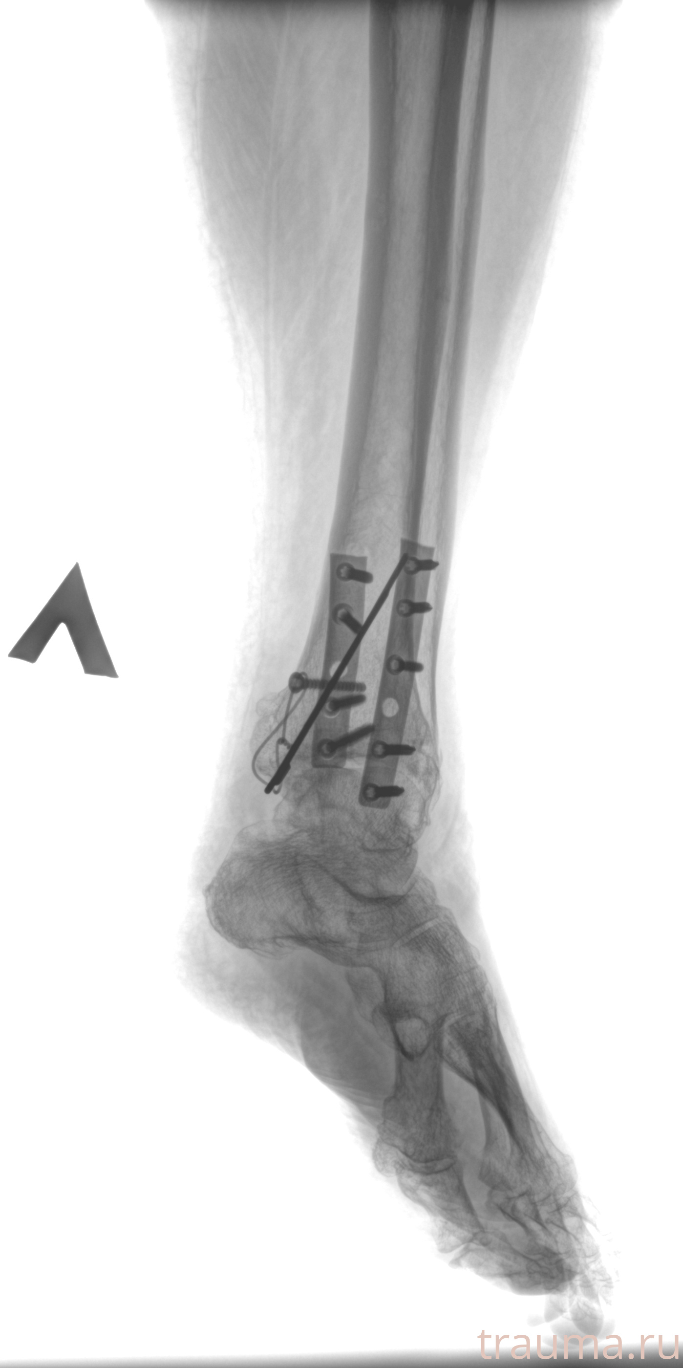 Рентген на дому: по вашему адресу приезжает врач-рентгенолог, травматолог-ортопед с мобильным рентгеновским аппаратом, проводит диагностику травмы или заболевания, делает необходимые рентгенограммы, дает рекомендации по дальнейшему лечению. Получить качественные снимки в домашних условиях возможно благодаря уникальной методике, разработанной МосРентген Центром для института  Склифосовского