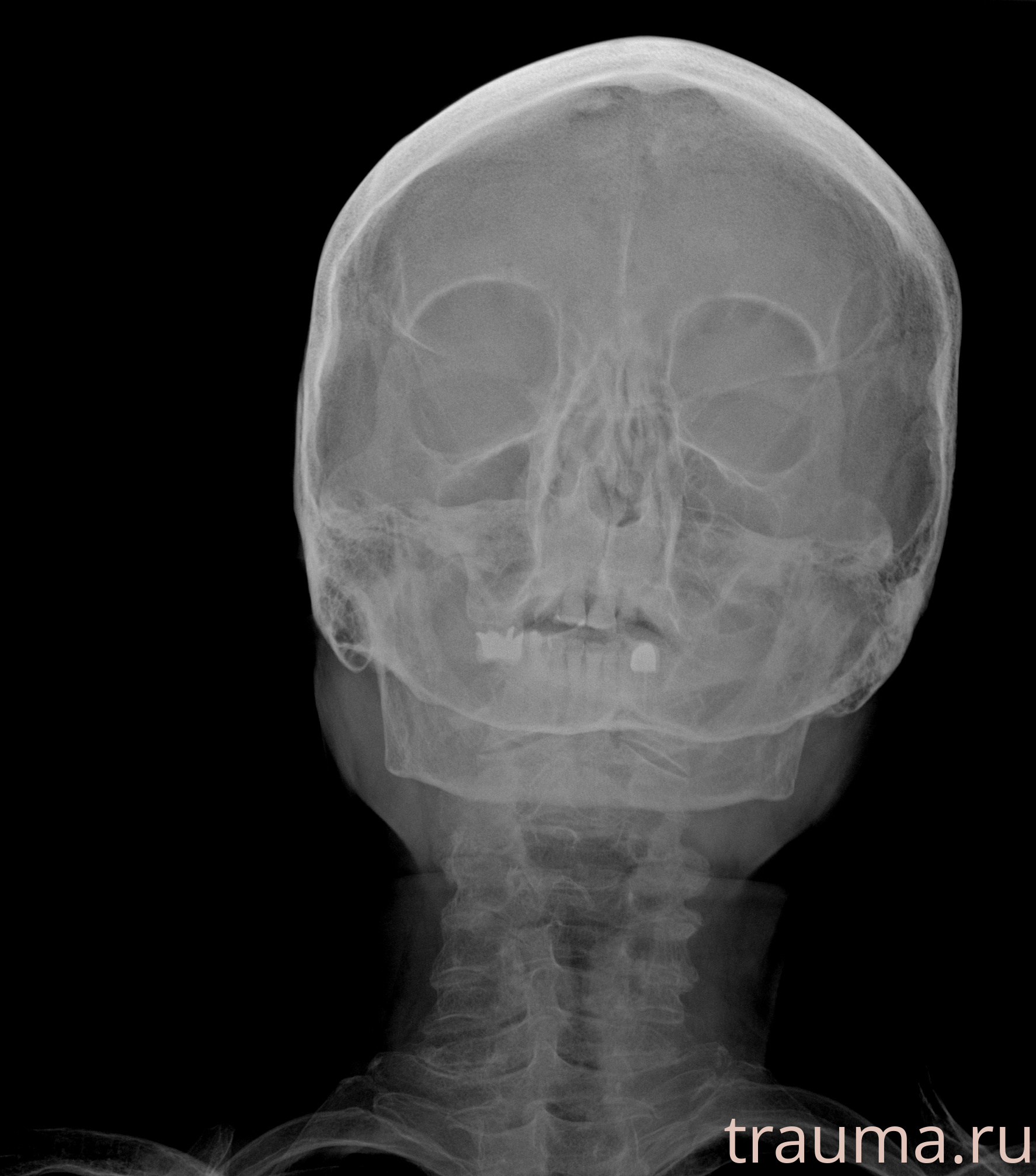 Рентген на дому: по вашему адресу приезжает врач-рентгенолог, травматолог-ортопед с мобильным рентгеновским аппаратом, проводит диагностику травмы или заболевания, делает необходимые рентгенограммы, дает рекомендации по дальнейшему лечению. Получить качественные снимки в домашних условиях возможно благодаря уникальной методике, разработанной МосРентген Центром для института  Склифосовского