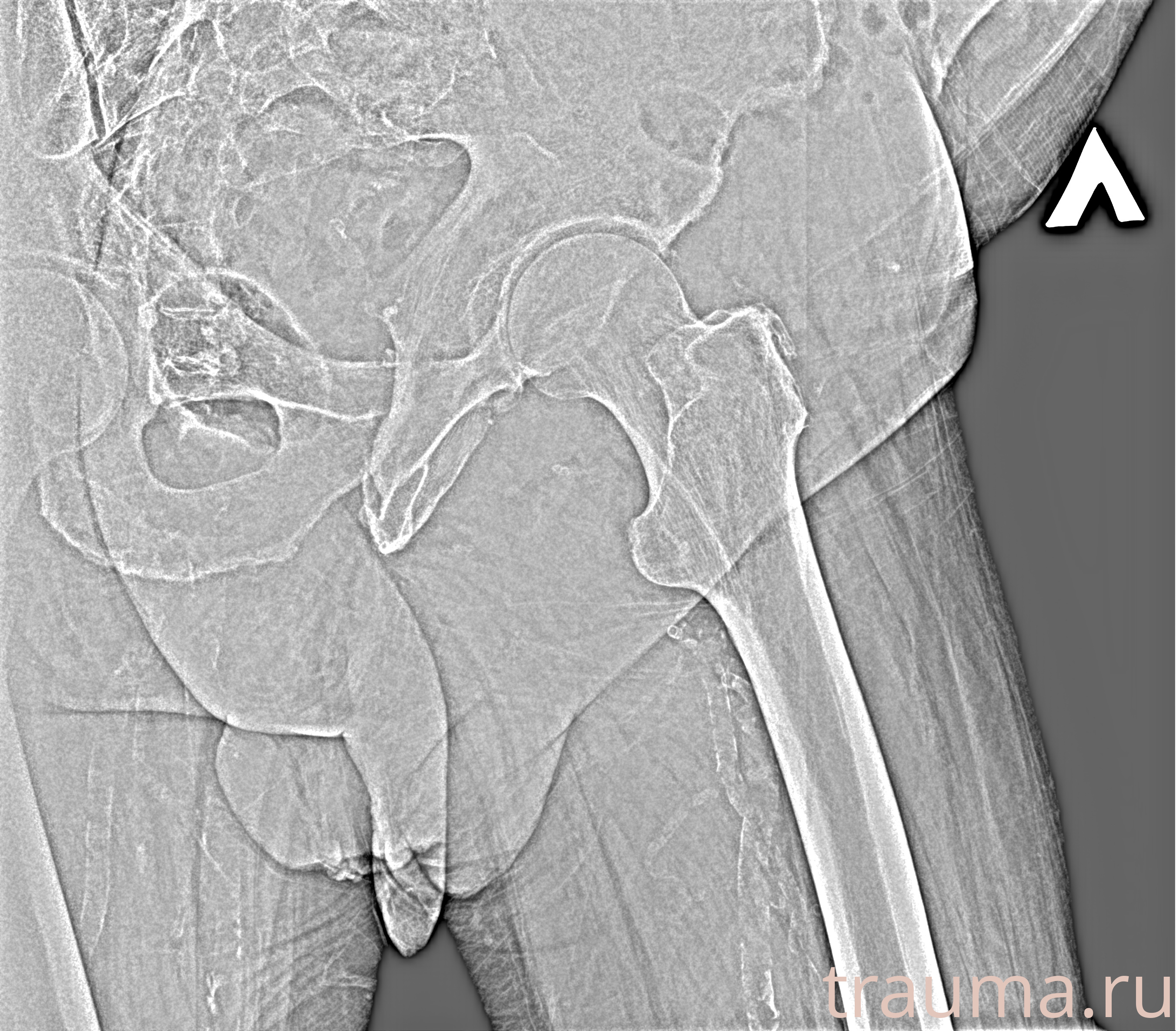 Рентген на дому: по вашему адресу приезжает врач-рентгенолог, травматолог-ортопед с мобильным рентгеновским аппаратом, проводит диагностику травмы или заболевания, делает необходимые рентгенограммы, дает рекомендации по дальнейшему лечению. Получить качественные снимки в домашних условиях возможно благодаря уникальной методике, разработанной МосРентген Центром для института  Склифосовского