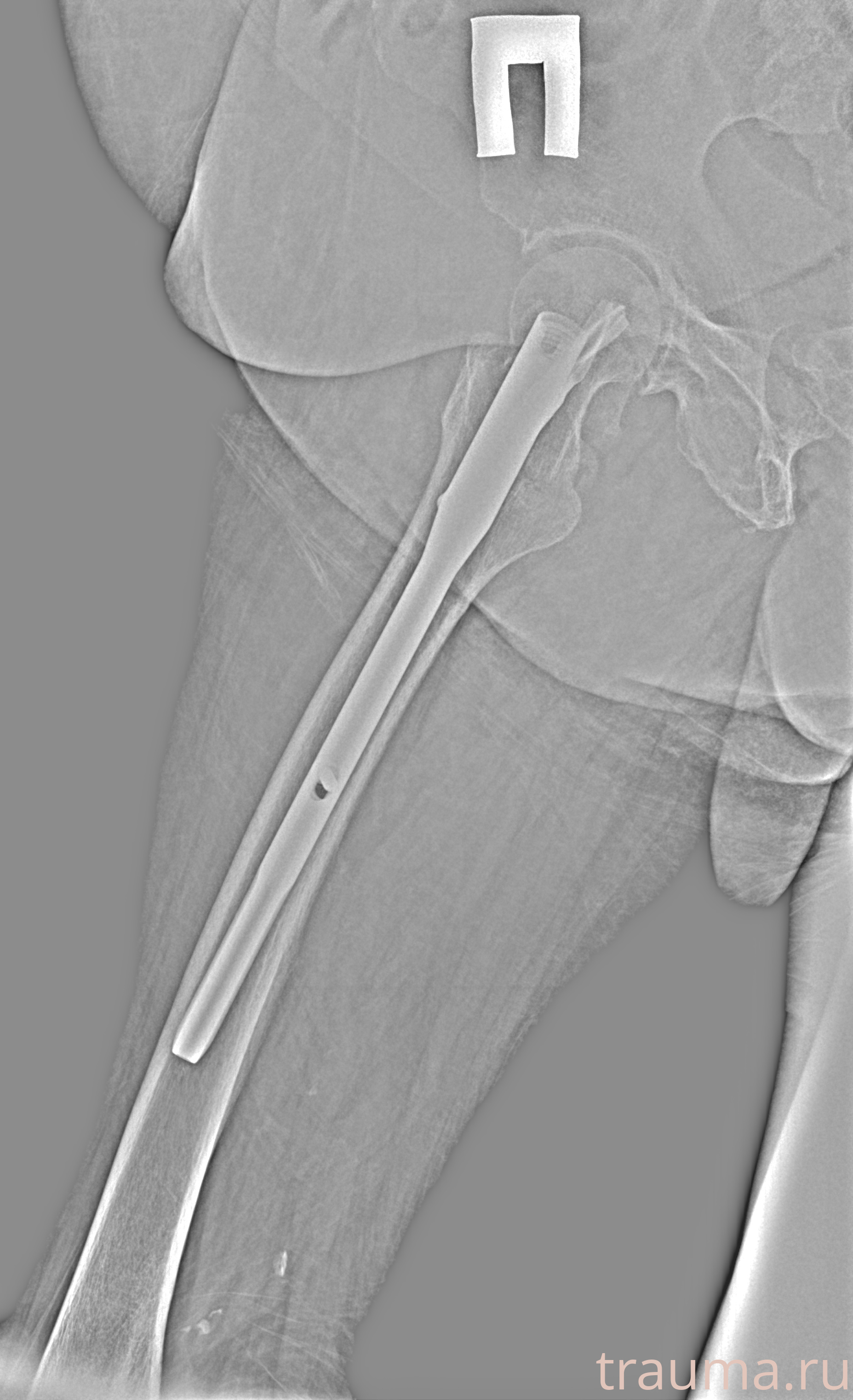 Рентген на дому: по вашему адресу приезжает врач-рентгенолог, травматолог-ортопед с мобильным рентгеновским аппаратом, проводит диагностику травмы или заболевания, делает необходимые рентгенограммы, дает рекомендации по дальнейшему лечению. Получить качественные снимки в домашних условиях возможно благодаря уникальной методике, разработанной МосРентген Центром для института  Склифосовского
