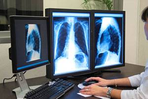 Цифровая флюорография в диагностике туберкулеза легких Цифровая флюорография в диагностике туберкулеза легких