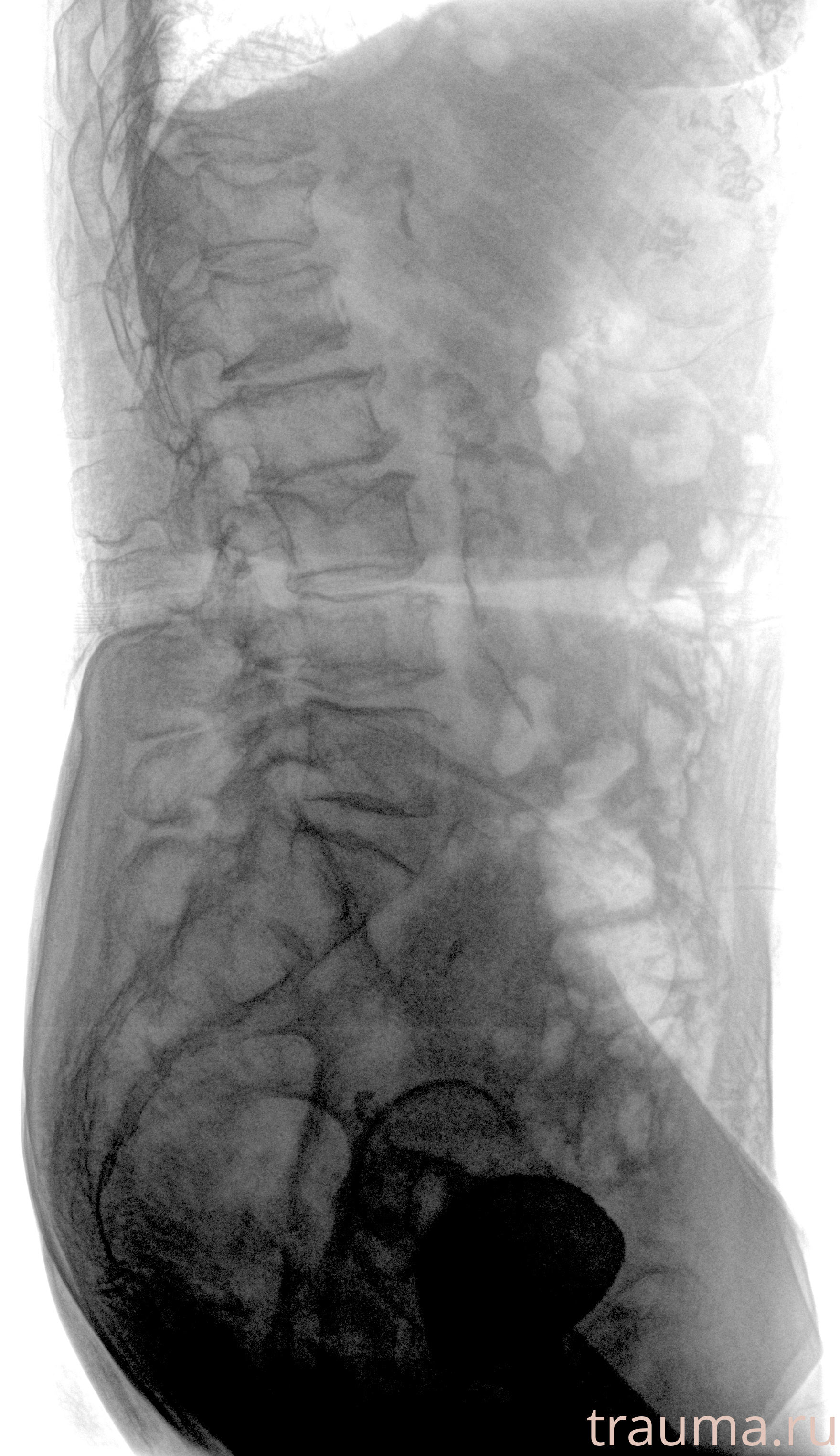 Рентген на дому: по вашему адресу приезжает врач-рентгенолог, травматолог-ортопед с мобильным рентгеновским аппаратом, проводит диагностику травмы или заболевания, делает необходимые рентгенограммы, дает рекомендации по дальнейшему лечению. Получить качественные снимки в домашних условиях возможно благодаря уникальной методике, разработанной МосРентген Центром для института  Склифосовского