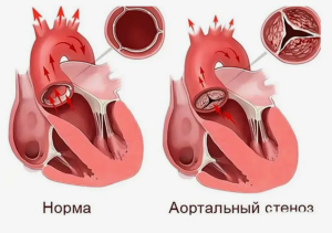 Клиническое наблюдение редкого осложнения тупой травмы груди: псевдоаневризма створки аортального клапана Клиническое наблюдение редкого осложнения тупой травмы груди: псевдоаневризма створки аортального клапана
