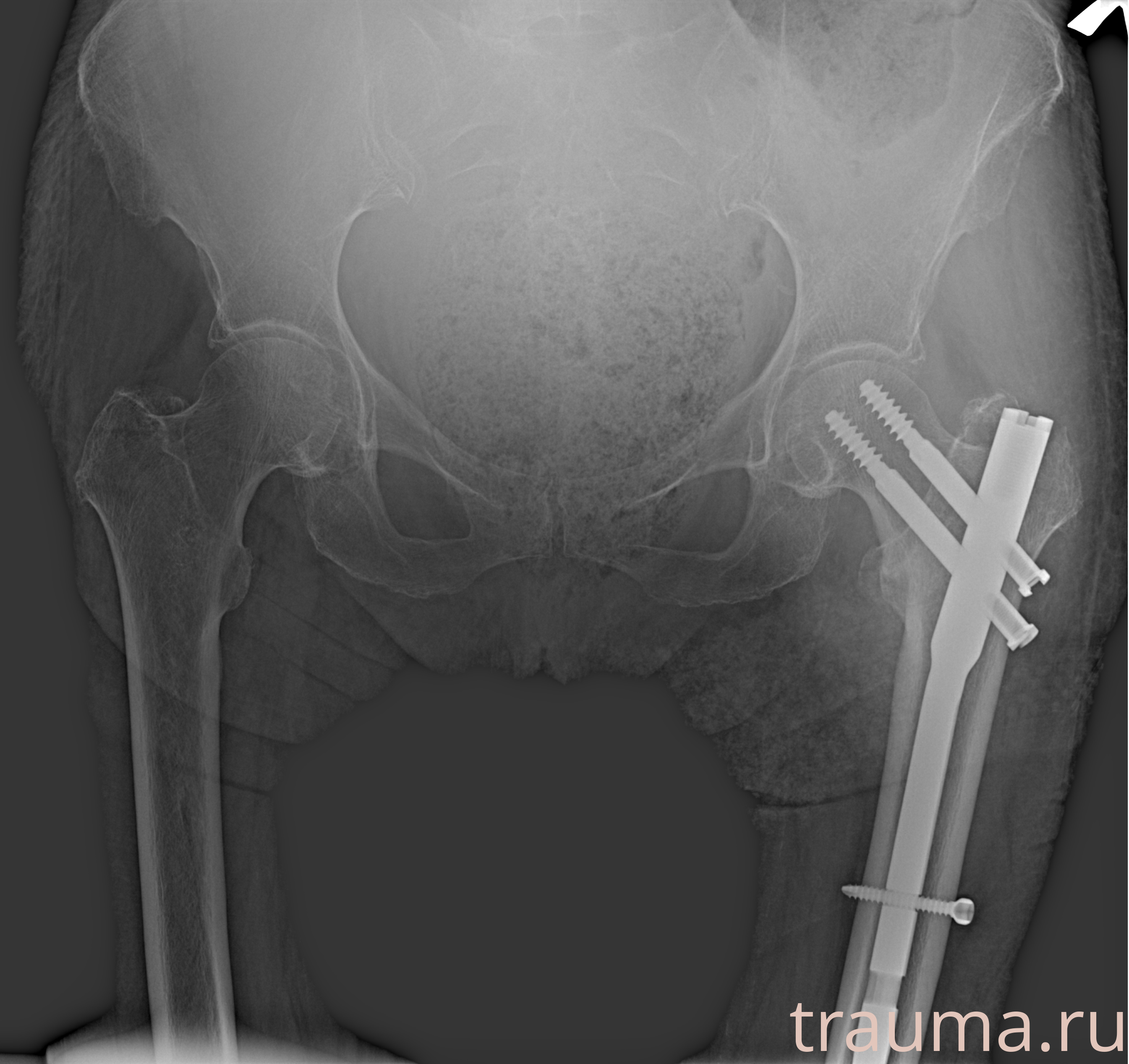 Рентген на дому: по вашему адресу приезжает врач-рентгенолог, травматолог-ортопед с мобильным рентгеновским аппаратом, проводит диагностику травмы или заболевания, делает необходимые рентгенограммы, дает рекомендации по дальнейшему лечению. Получить качественные снимки в домашних условиях возможно благодаря уникальной методике, разработанной МосРентген Центром для института  Склифосовского