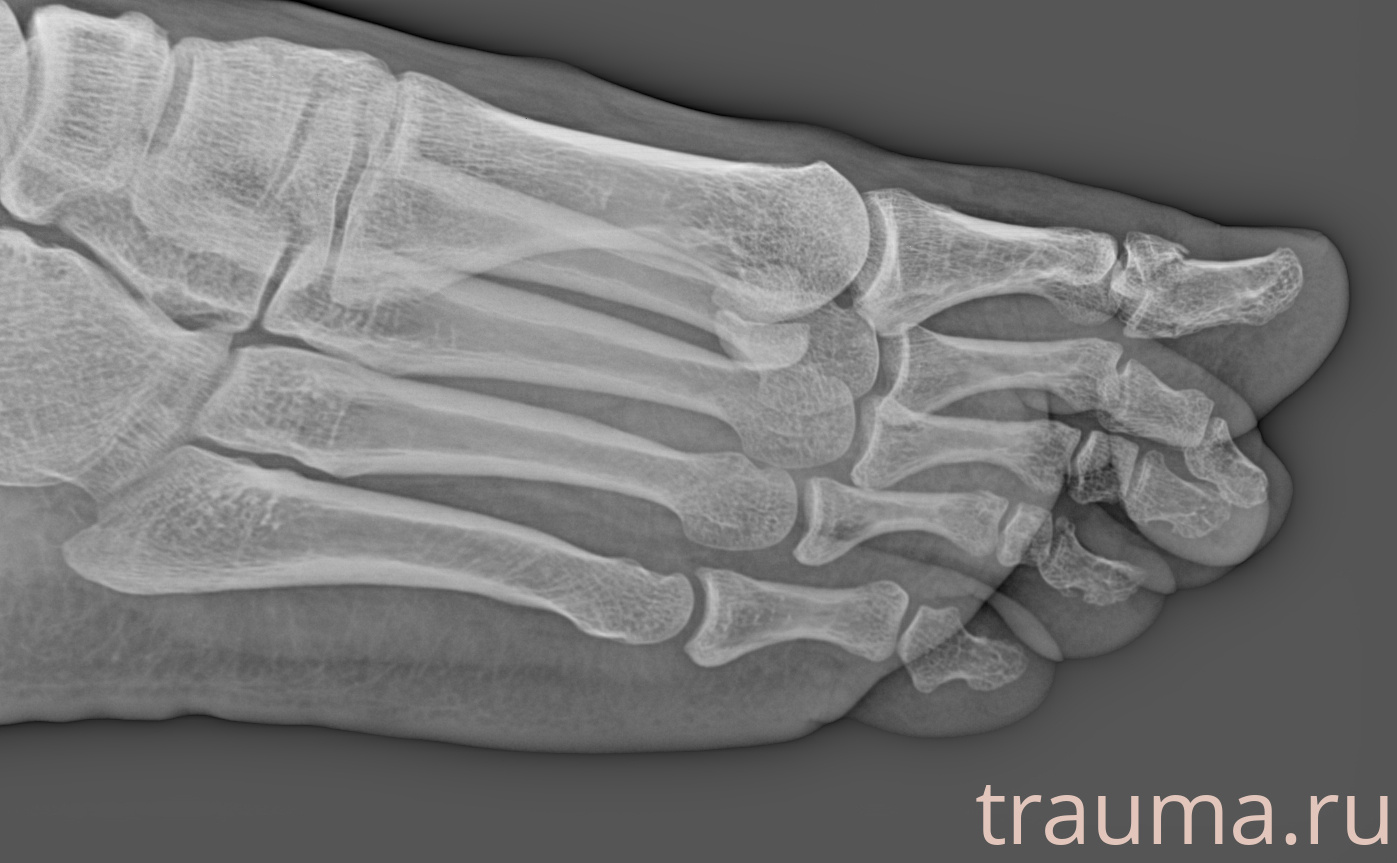 Рентген на дому: по вашему адресу приезжает врач-рентгенолог, травматолог-ортопед с мобильным рентгеновским аппаратом, проводит диагностику травмы или заболевания, делает необходимые рентгенограммы, дает рекомендации по дальнейшему лечению. Получить качественные снимки в домашних условиях возможно благодаря уникальной методике, разработанной МосРентген Центром для института  Склифосовского