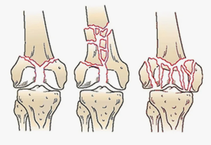 Сравнительно-аналитическое исследование повреждений крупных суставов при уличной и бытовой травмах