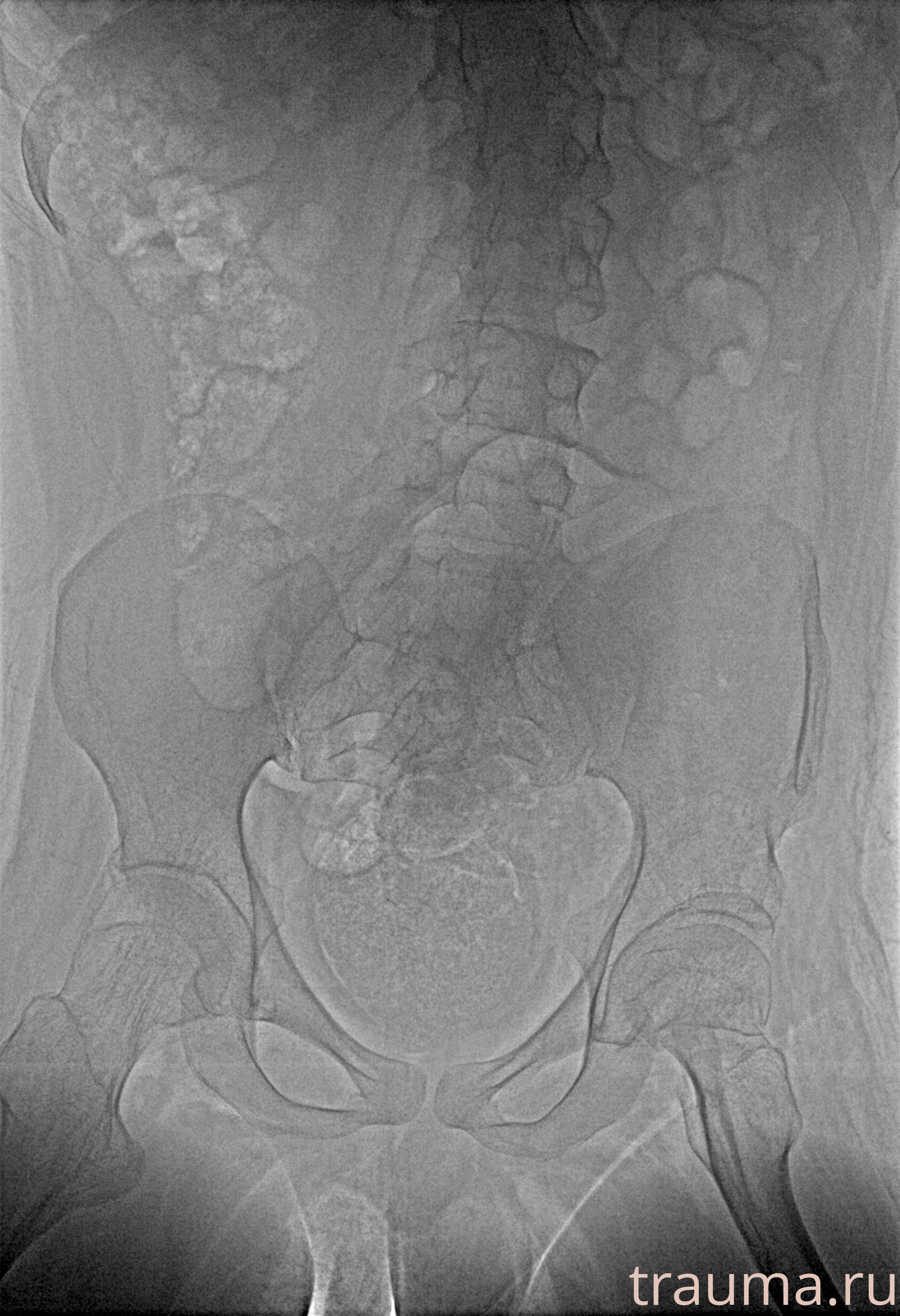 Рентген на дому: по вашему адресу приезжает врач-рентгенолог, травматолог-ортопед с мобильным рентгеновским аппаратом, проводит диагностику травмы или заболевания, делает необходимые рентгенограммы, дает рекомендации по дальнейшему лечению. Получить качественные снимки в домашних условиях возможно благодаря уникальной методике, разработанной МосРентген Центром для института  Склифосовского