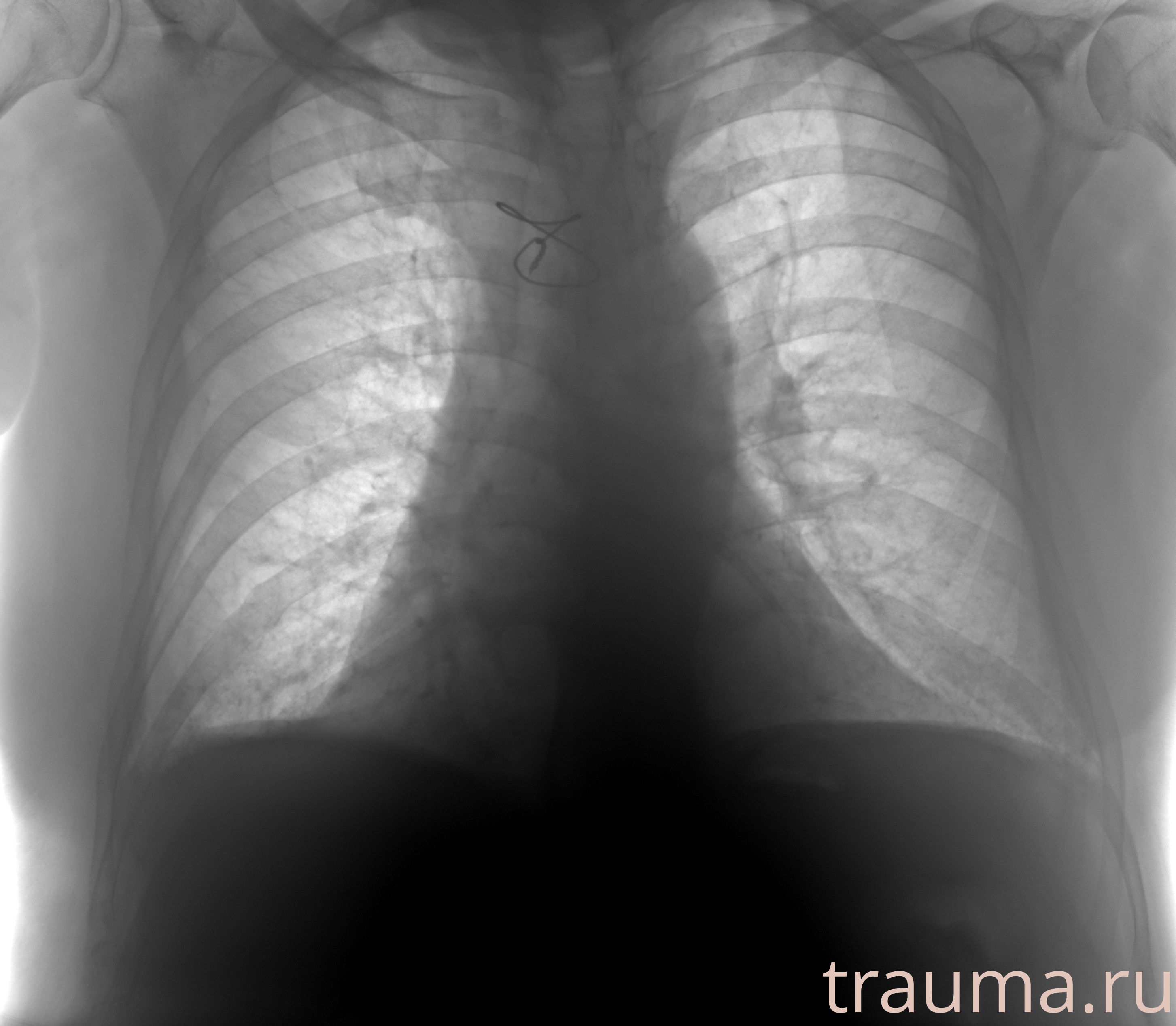 Рентген на дому: по вашему адресу приезжает врач-рентгенолог, травматолог-ортопед с мобильным рентгеновским аппаратом, проводит диагностику травмы или заболевания, делает необходимые рентгенограммы, дает рекомендации по дальнейшему лечению. Получить качественные снимки в домашних условиях возможно благодаря уникальной методике, разработанной МосРентген Центром для института  Склифосовского