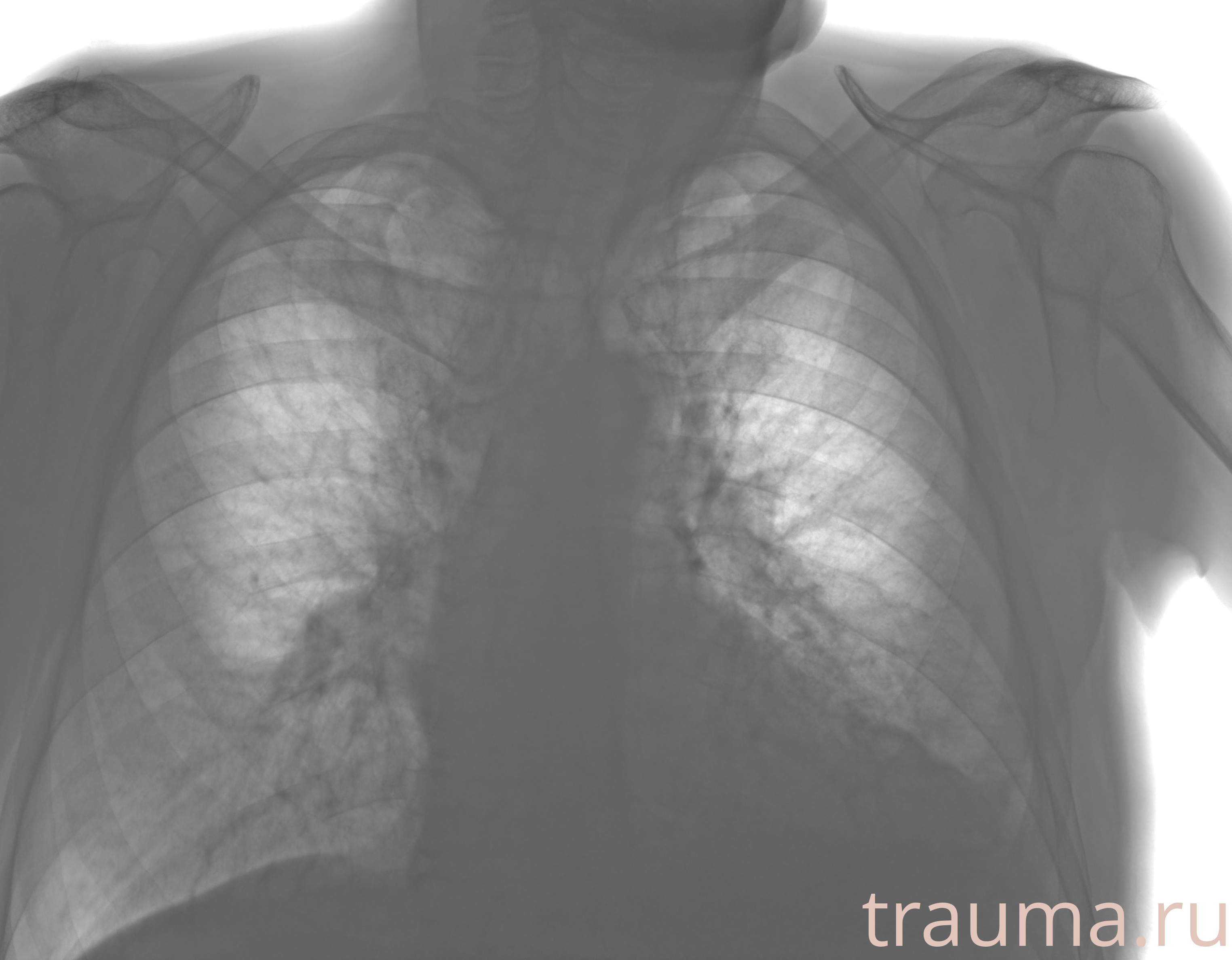 Рентген на дому: по вашему адресу приезжает врач-рентгенолог, травматолог-ортопед с мобильным рентгеновским аппаратом, проводит диагностику травмы или заболевания, делает необходимые рентгенограммы, дает рекомендации по дальнейшему лечению. Получить качественные снимки в домашних условиях возможно благодаря уникальной методике, разработанной МосРентген Центром для института  Склифосовского