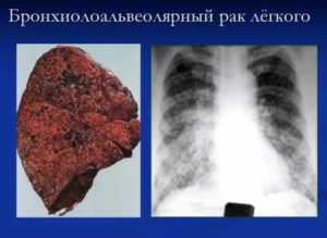 Дифференциальная рентгенодиагностика заболеваний органов дыхания и средостения(часть 11) Дифференциальная рентгенодиагностика заболеваний органов дыхания и средостения(часть 11)