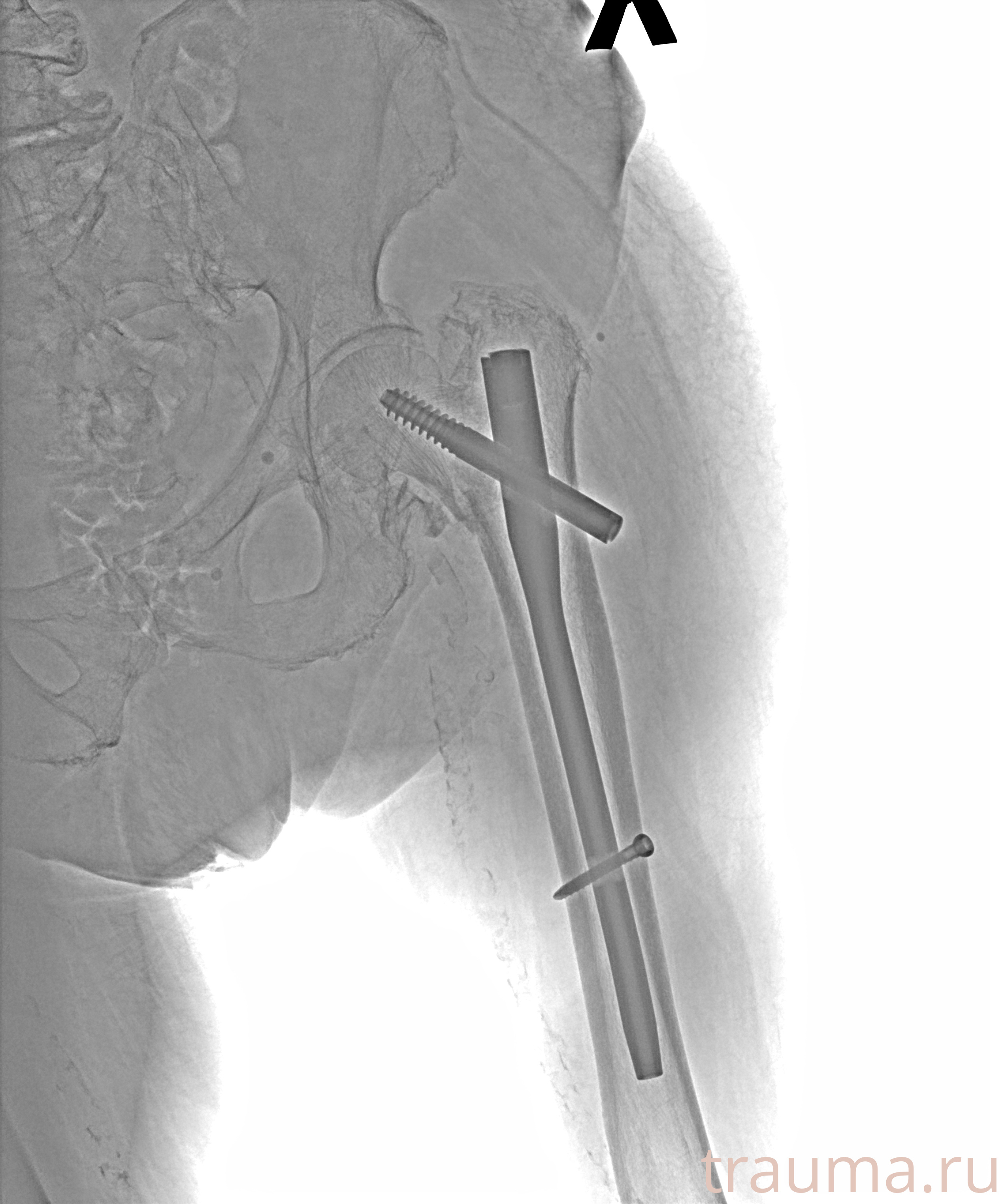 Рентген на дому: по вашему адресу приезжает врач-рентгенолог, травматолог-ортопед с мобильным рентгеновским аппаратом, проводит диагностику травмы или заболевания, делает необходимые рентгенограммы, дает рекомендации по дальнейшему лечению. Получить качественные снимки в домашних условиях возможно благодаря уникальной методике, разработанной МосРентген Центром для института  Склифосовского