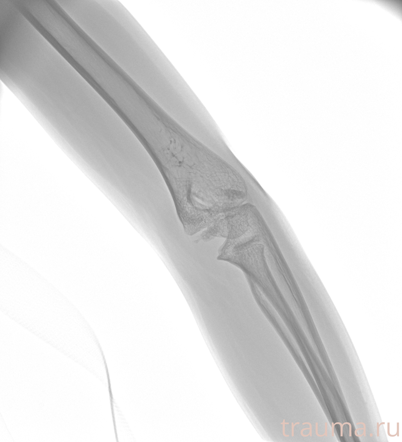 Рентген на дому: по вашему адресу приезжает врач-рентгенолог, травматолог-ортопед с мобильным рентгеновским аппаратом, проводит диагностику травмы или заболевания, делает необходимые рентгенограммы, дает рекомендации по дальнейшему лечению. Получить качественные снимки в домашних условиях возможно благодаря уникальной методике, разработанной МосРентген Центром для института  Склифосовского