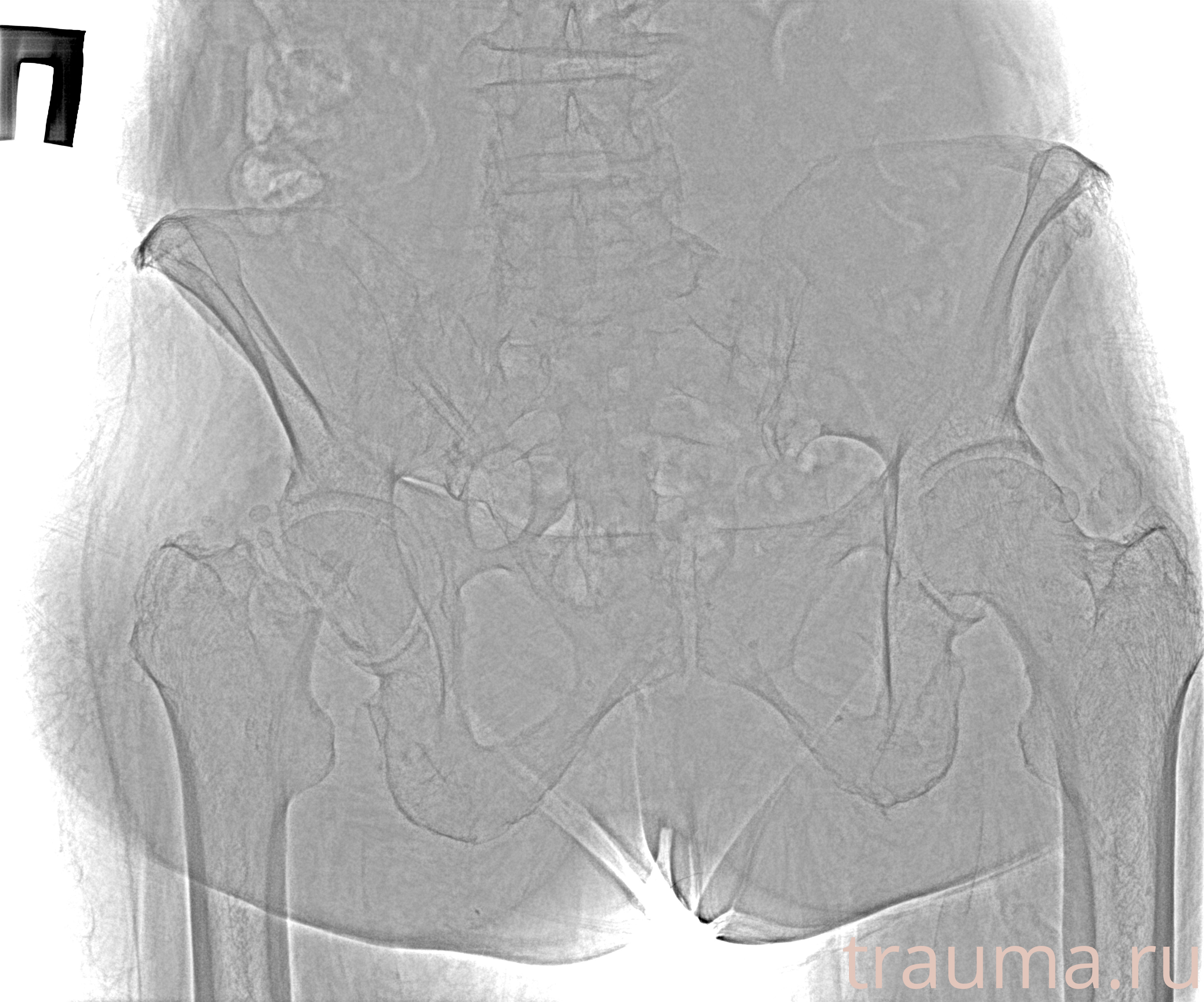 Рентген на дому: по вашему адресу приезжает врач-рентгенолог, травматолог-ортопед с мобильным рентгеновским аппаратом, проводит диагностику травмы или заболевания, делает необходимые рентгенограммы, дает рекомендации по дальнейшему лечению. Получить качественные снимки в домашних условиях возможно благодаря уникальной методике, разработанной МосРентген Центром для института  Склифосовского
