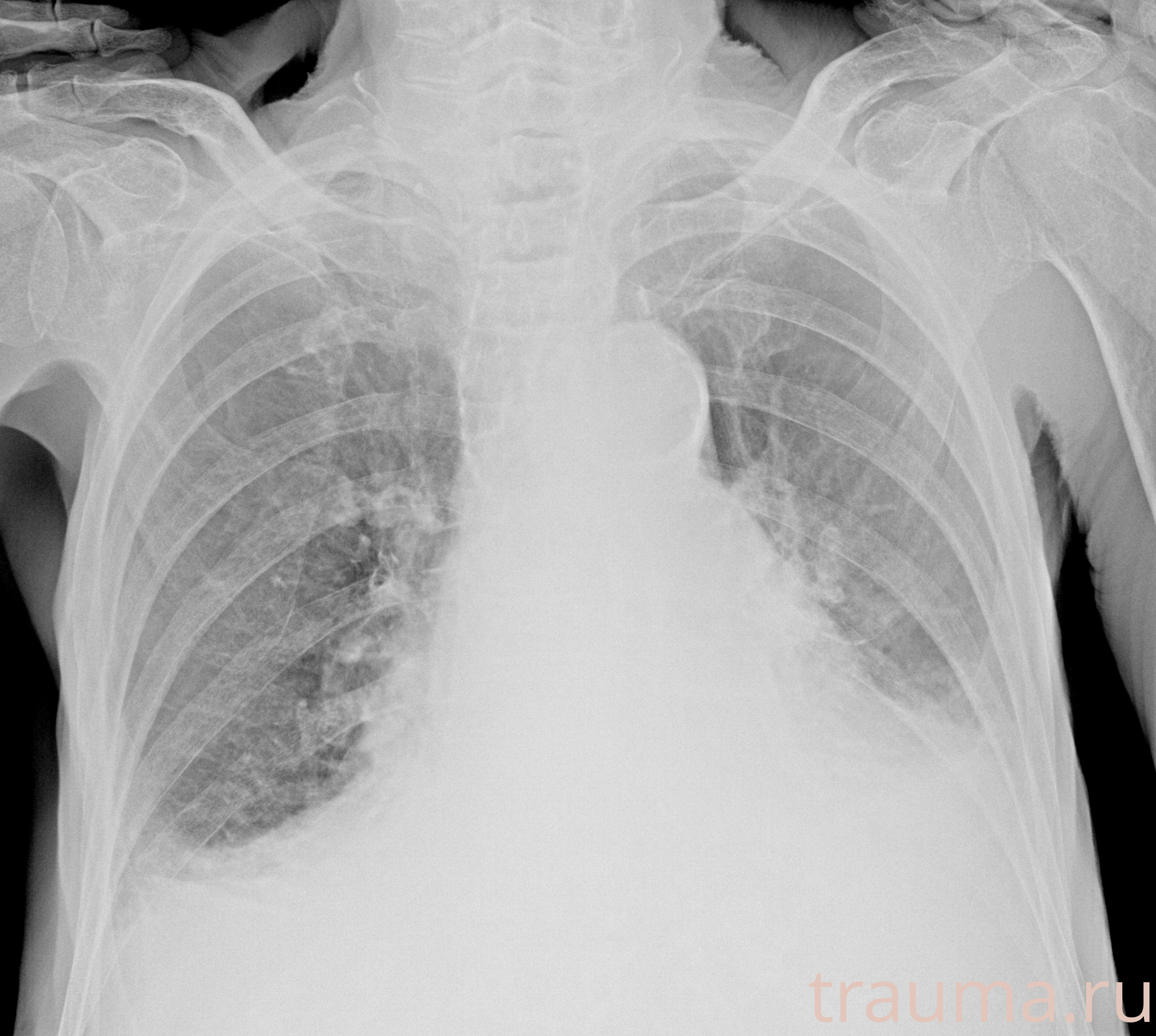 Рентген на дому: по вашему адресу приезжает врач-рентгенолог, травматолог-ортопед с мобильным рентгеновским аппаратом, проводит диагностику травмы или заболевания, делает необходимые рентгенограммы, дает рекомендации по дальнейшему лечению. Получить качественные снимки в домашних условиях возможно благодаря уникальной методике, разработанной МосРентген Центром для института  Склифосовского