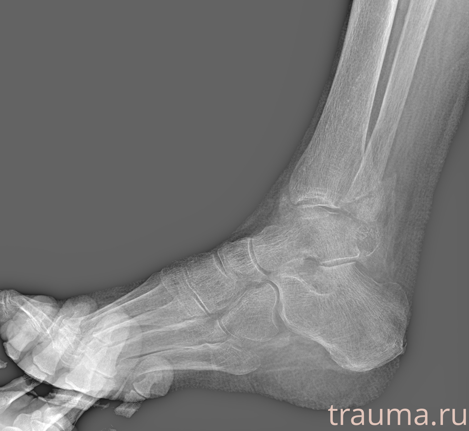 Рентген на дому: по вашему адресу приезжает врач-рентгенолог, травматолог-ортопед с мобильным рентгеновским аппаратом, проводит диагностику травмы или заболевания, делает необходимые рентгенограммы, дает рекомендации по дальнейшему лечению. Получить качественные снимки в домашних условиях возможно благодаря уникальной методике, разработанной МосРентген Центром для института  Склифосовского