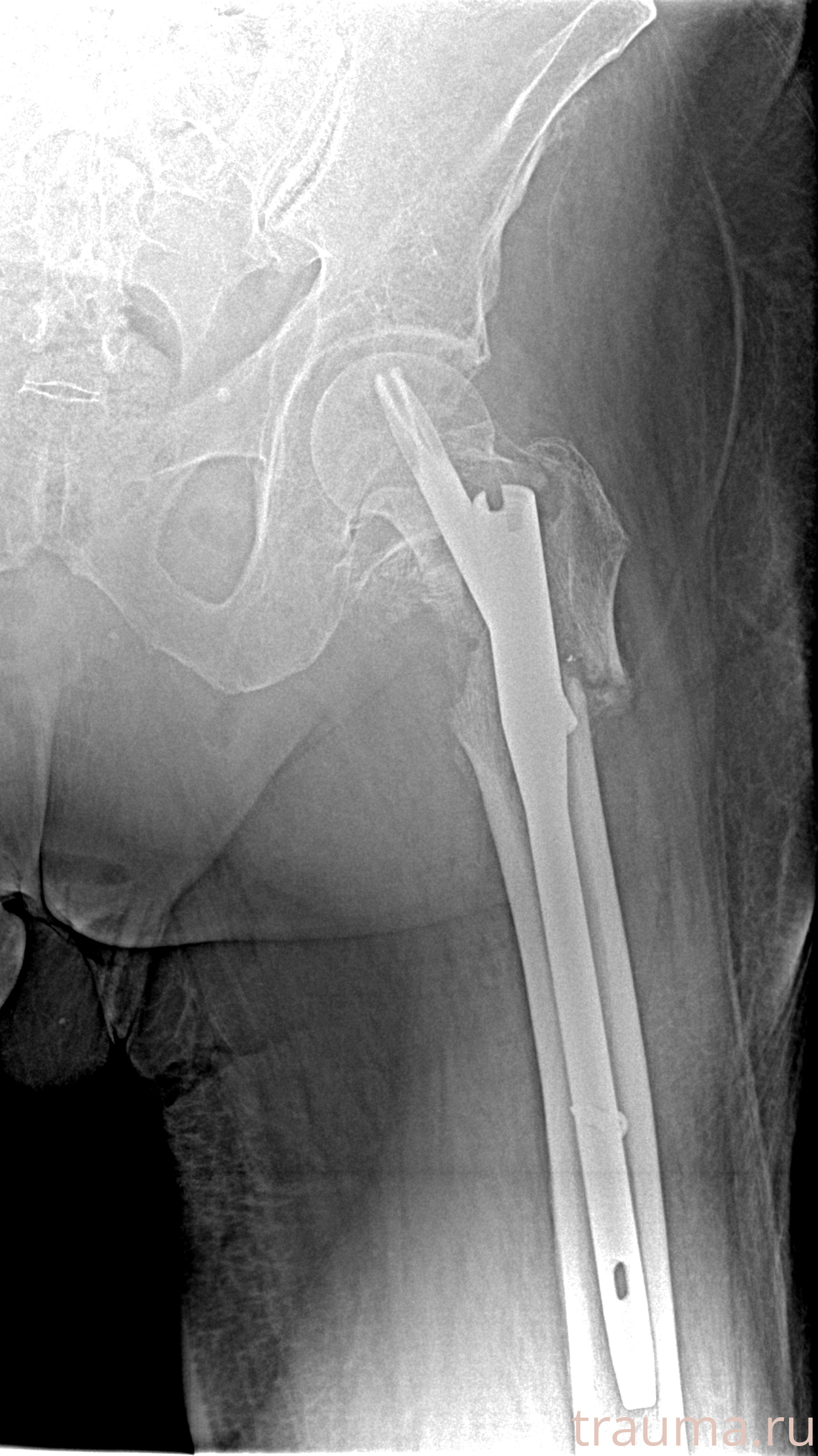 Рентген на дому: по вашему адресу приезжает врач-рентгенолог, травматолог-ортопед с мобильным рентгеновским аппаратом, проводит диагностику травмы или заболевания, делает необходимые рентгенограммы, дает рекомендации по дальнейшему лечению. Получить качественные снимки в домашних условиях возможно благодаря уникальной методике, разработанной МосРентген Центром для института  Склифосовского