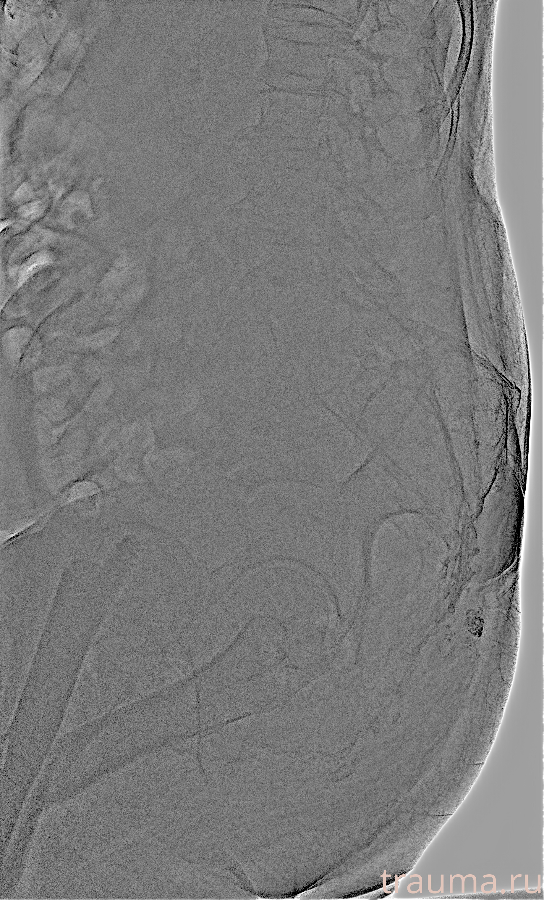 Рентген на дому: по вашему адресу приезжает врач-рентгенолог, травматолог-ортопед с мобильным рентгеновским аппаратом, проводит диагностику травмы или заболевания, делает необходимые рентгенограммы, дает рекомендации по дальнейшему лечению. Получить качественные снимки в домашних условиях возможно благодаря уникальной методике, разработанной МосРентген Центром для института  Склифосовского