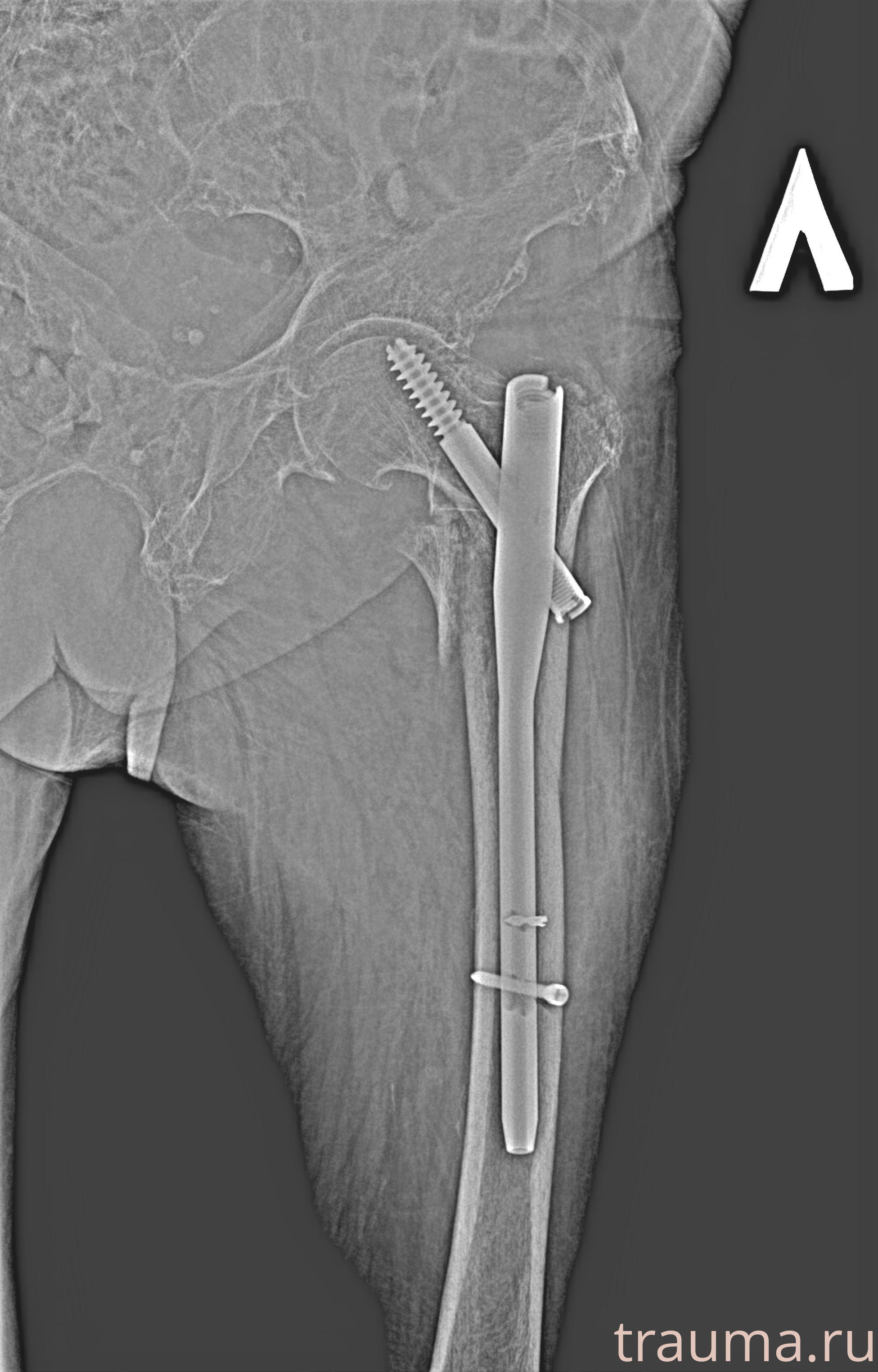 Рентген на дому: по вашему адресу приезжает врач-рентгенолог, травматолог-ортопед с мобильным рентгеновским аппаратом, проводит диагностику травмы или заболевания, делает необходимые рентгенограммы, дает рекомендации по дальнейшему лечению. Получить качественные снимки в домашних условиях возможно благодаря уникальной методике, разработанной МосРентген Центром для института  Склифосовского