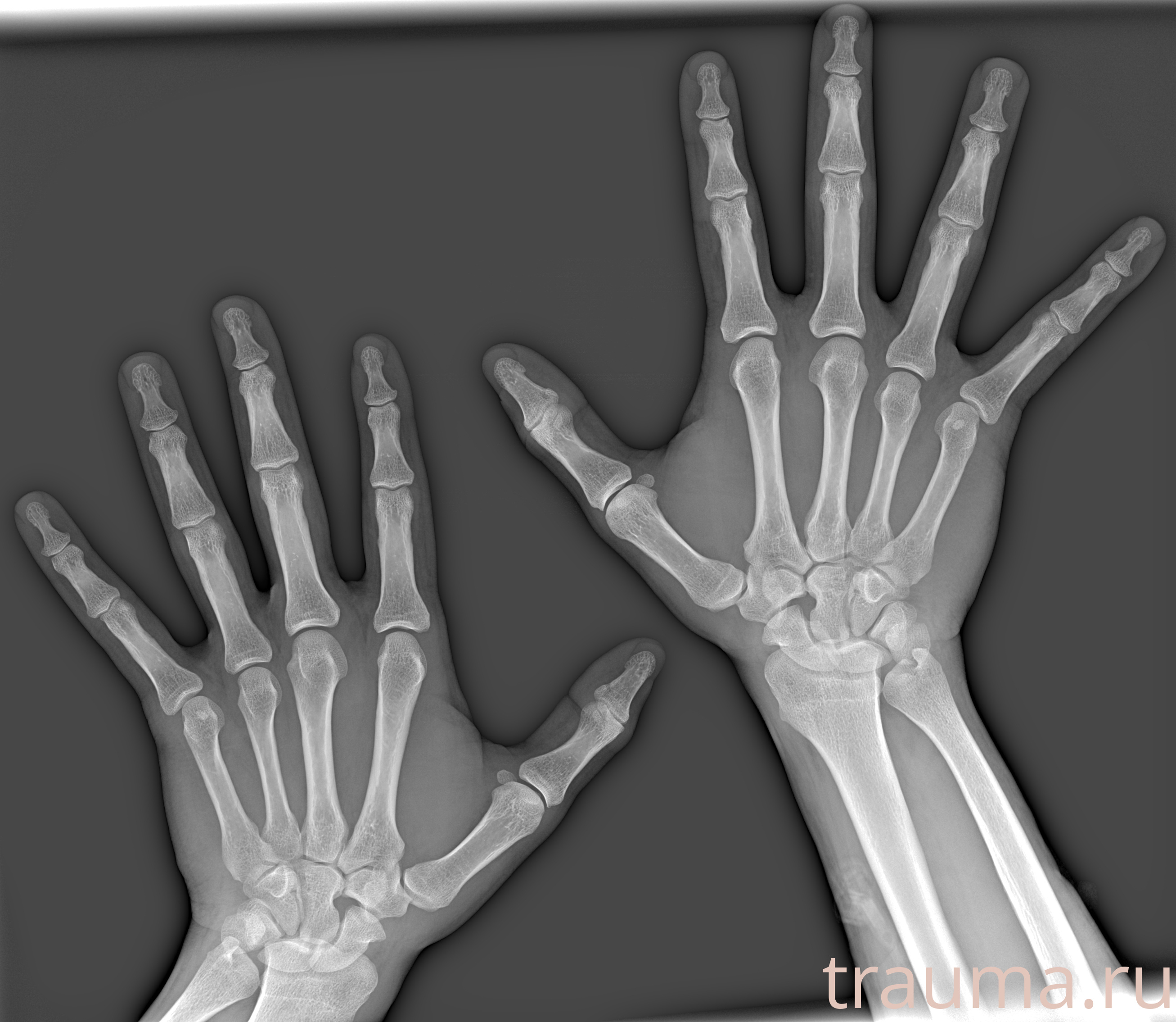 Рентген на дому: по вашему адресу приезжает врач-рентгенолог, травматолог-ортопед с мобильным рентгеновским аппаратом, проводит диагностику травмы или заболевания, делает необходимые рентгенограммы, дает рекомендации по дальнейшему лечению. Получить качественные снимки в домашних условиях возможно благодаря уникальной методике, разработанной МосРентген Центром для института  Склифосовского