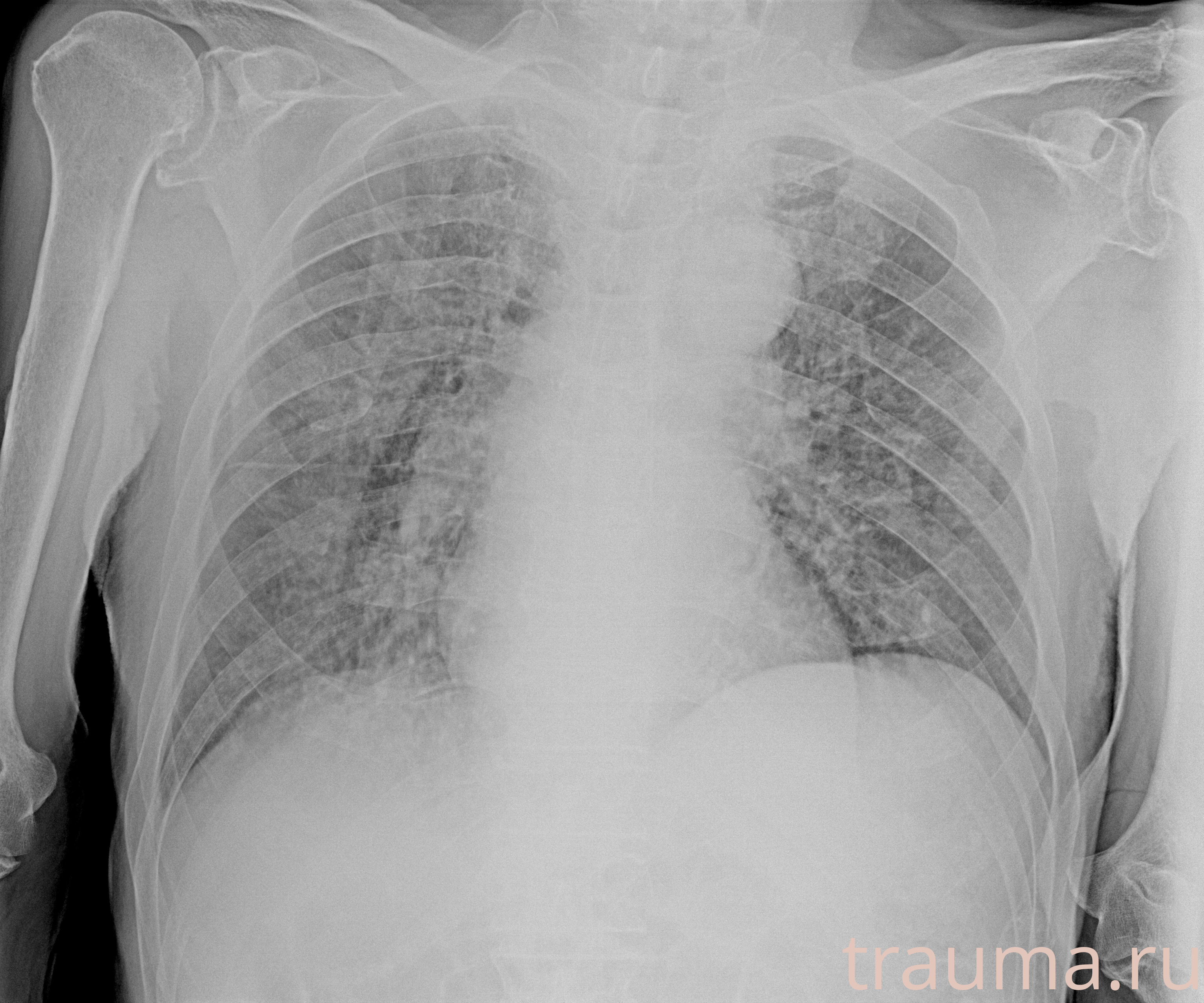 Рентген на дому: по вашему адресу приезжает врач-рентгенолог, травматолог-ортопед с мобильным рентгеновским аппаратом, проводит диагностику травмы или заболевания, делает необходимые рентгенограммы, дает рекомендации по дальнейшему лечению. Получить качественные снимки в домашних условиях возможно благодаря уникальной методике, разработанной МосРентген Центром для института  Склифосовского