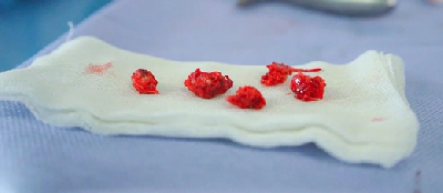 Специалисты Склифа впервые в России извлекли его через маленькие проколы в грудной клетке Специалисты Склифа впервые в России извлекли его через маленькие проколы в грудной клетке