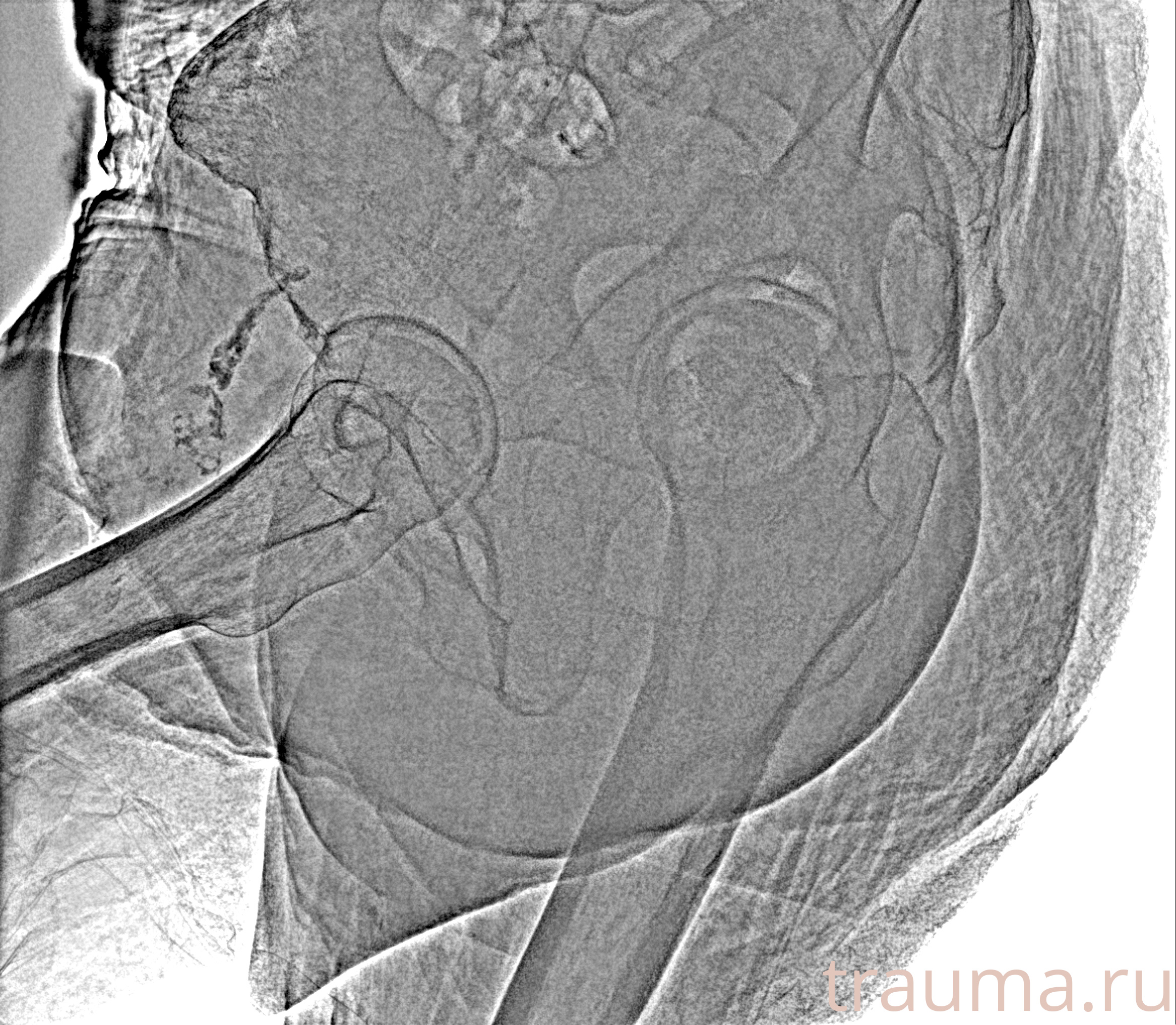 Рентген на дому: по вашему адресу приезжает врач-рентгенолог, травматолог-ортопед с мобильным рентгеновским аппаратом, проводит диагностику травмы или заболевания, делает необходимые рентгенограммы, дает рекомендации по дальнейшему лечению. Получить качественные снимки в домашних условиях возможно благодаря уникальной методике, разработанной МосРентген Центром для института  Склифосовского