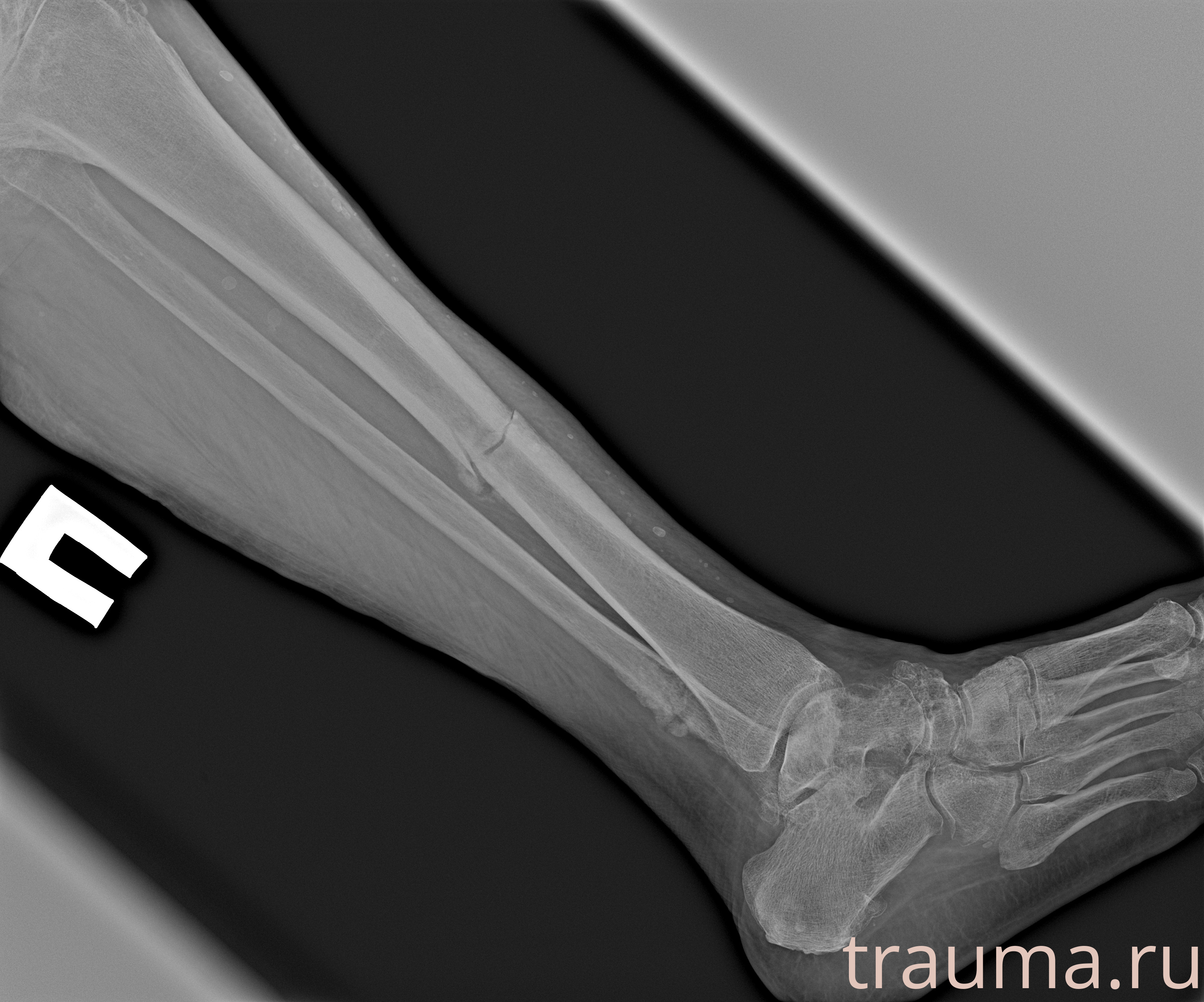 Рентген на дому: по вашему адресу приезжает врач-рентгенолог, травматолог-ортопед с мобильным рентгеновским аппаратом, проводит диагностику травмы или заболевания, делает необходимые рентгенограммы, дает рекомендации по дальнейшему лечению. Получить качественные снимки в домашних условиях возможно благодаря уникальной методике, разработанной МосРентген Центром для института  Склифосовского