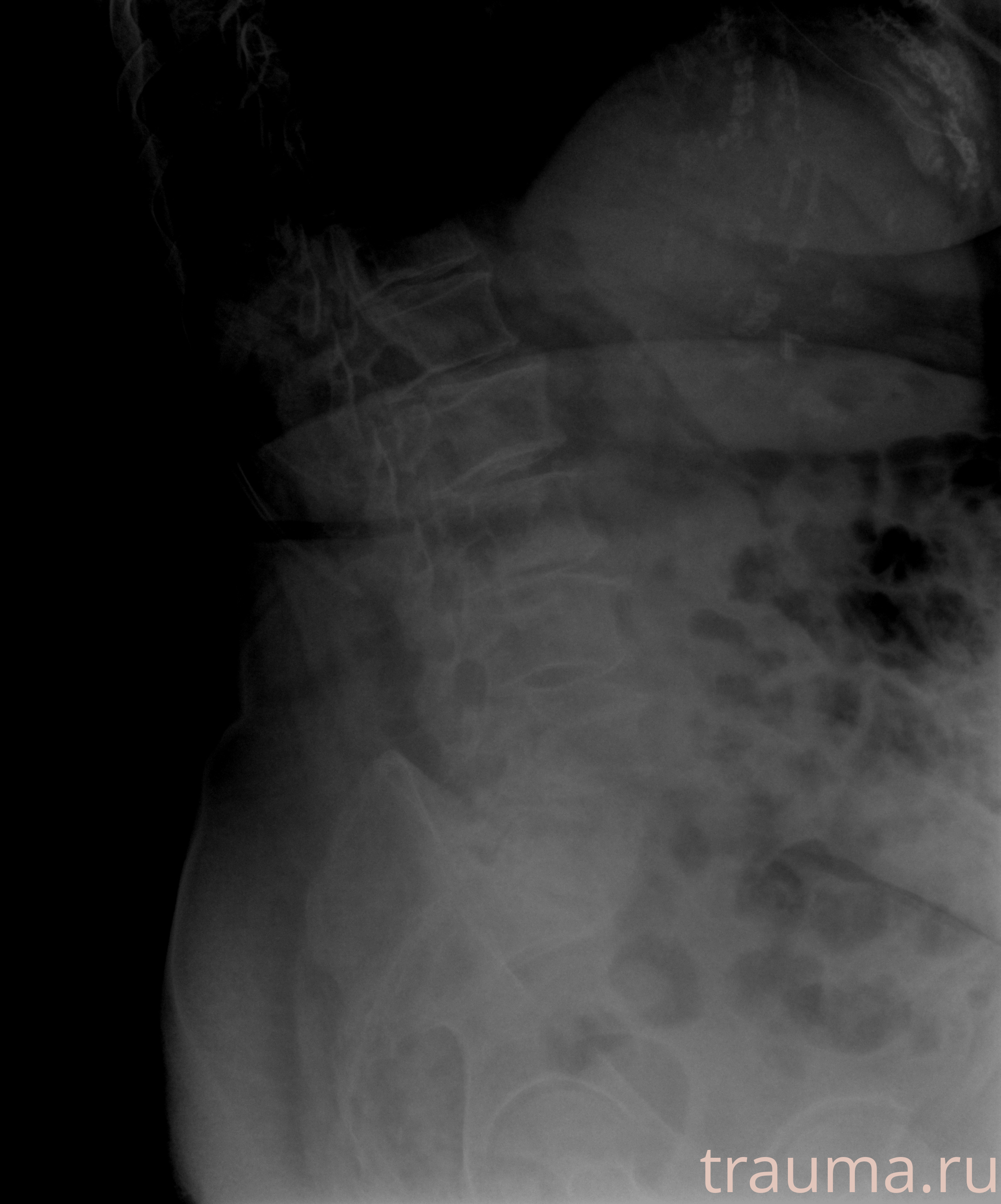 Рентген на дому: по вашему адресу приезжает врач-рентгенолог, травматолог-ортопед с мобильным рентгеновским аппаратом, проводит диагностику травмы или заболевания, делает необходимые рентгенограммы, дает рекомендации по дальнейшему лечению. Получить качественные снимки в домашних условиях возможно благодаря уникальной методике, разработанной МосРентген Центром для института  Склифосовского