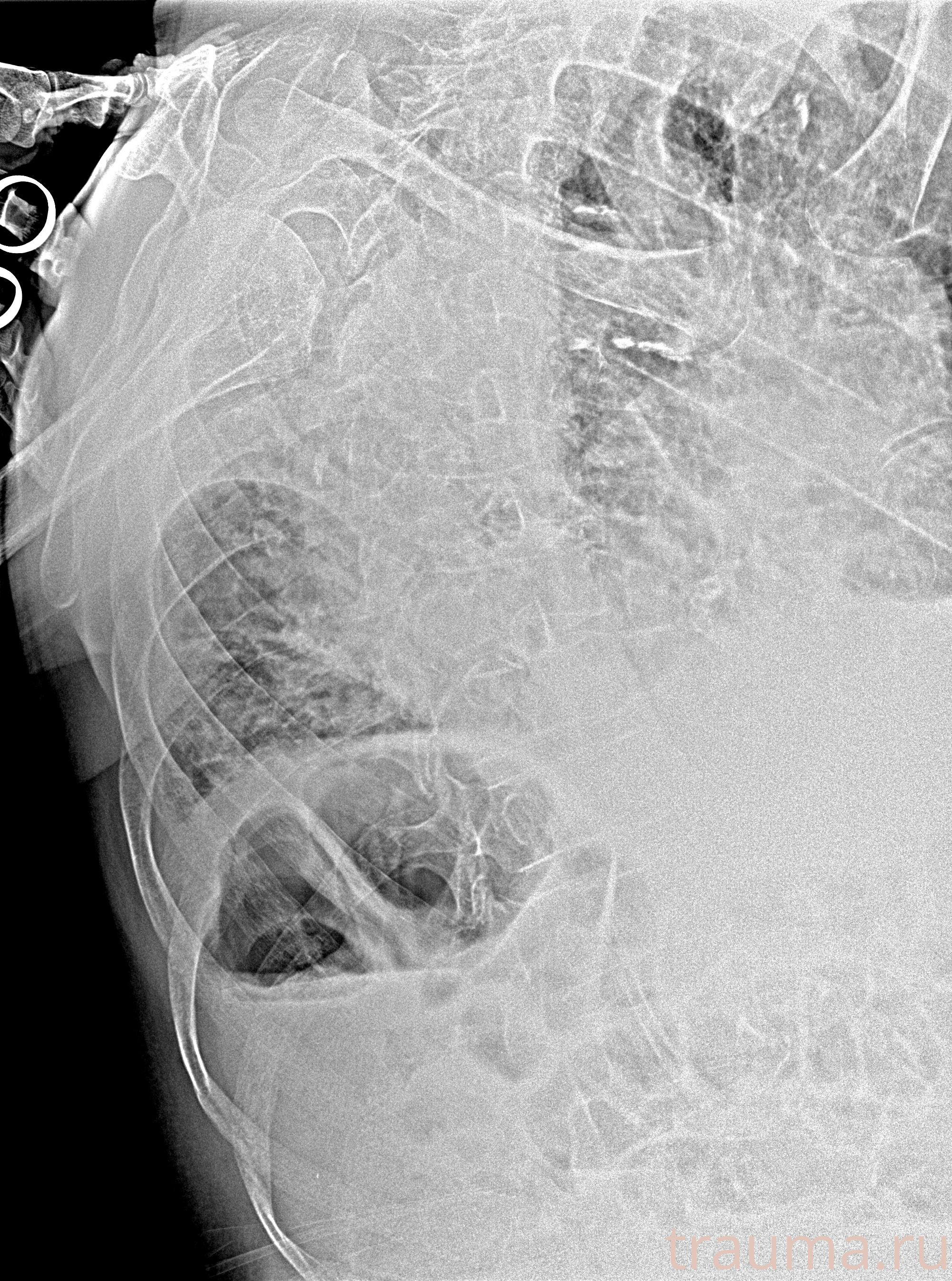 Рентген на дому: по вашему адресу приезжает врач-рентгенолог, травматолог-ортопед с мобильным рентгеновским аппаратом, проводит диагностику травмы или заболевания, делает необходимые рентгенограммы, дает рекомендации по дальнейшему лечению. Получить качественные снимки в домашних условиях возможно благодаря уникальной методике, разработанной МосРентген Центром для института  Склифосовского