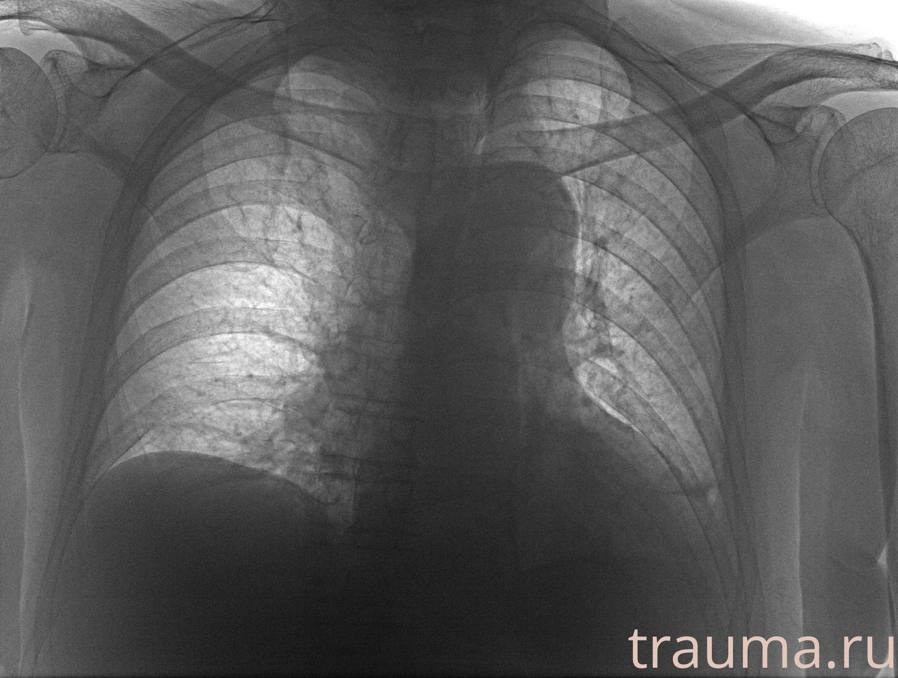 Рентген на дому: по вашему адресу приезжает врач-рентгенолог, травматолог-ортопед с мобильным рентгеновским аппаратом, проводит диагностику травмы или заболевания, делает необходимые рентгенограммы, дает рекомендации по дальнейшему лечению. Получить качественные снимки в домашних условиях возможно благодаря уникальной методике, разработанной МосРентген Центром для института  Склифосовского