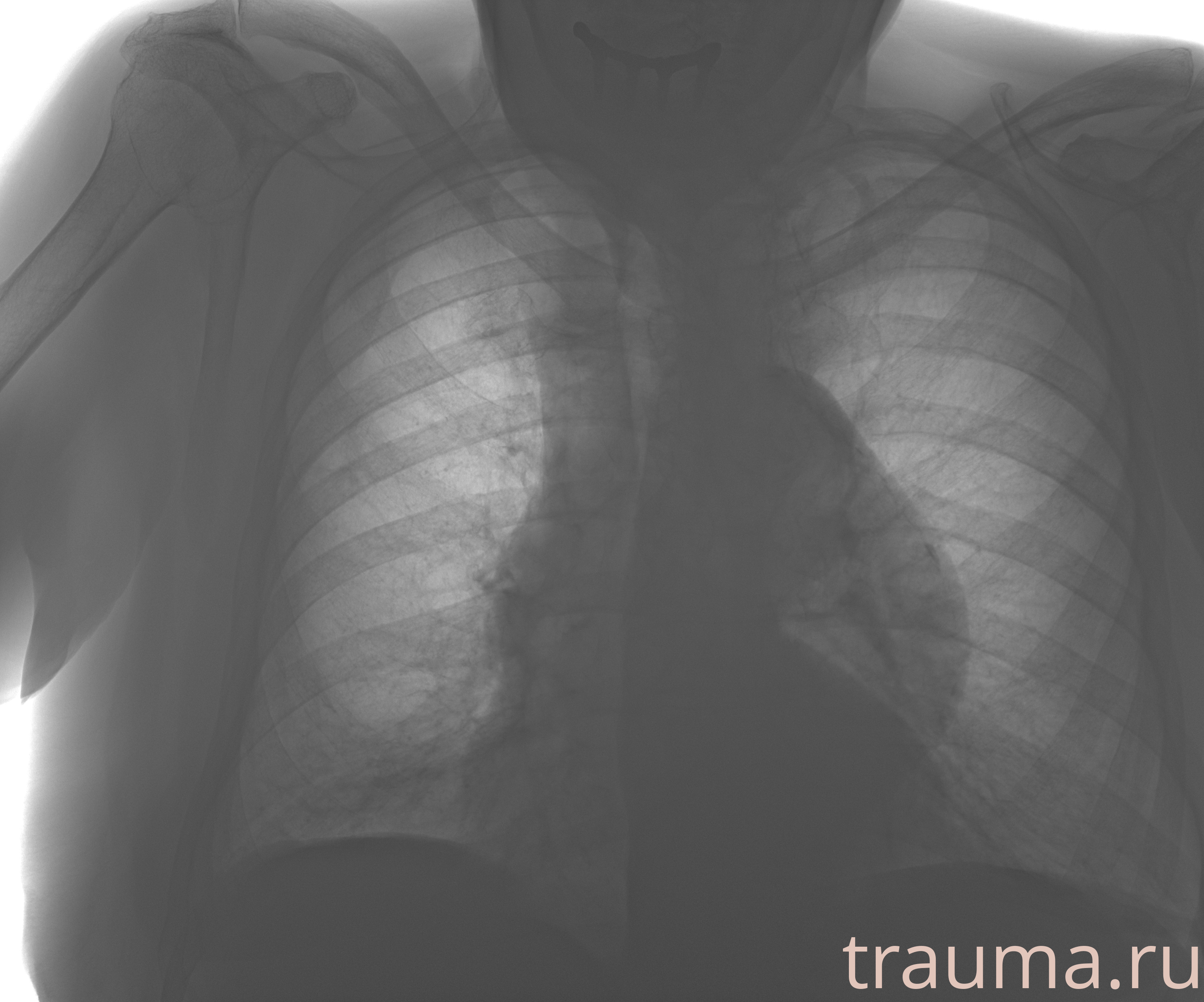 Рентген на дому: по вашему адресу приезжает врач-рентгенолог, травматолог-ортопед с мобильным рентгеновским аппаратом, проводит диагностику травмы или заболевания, делает необходимые рентгенограммы, дает рекомендации по дальнейшему лечению. Получить качественные снимки в домашних условиях возможно благодаря уникальной методике, разработанной МосРентген Центром для института  Склифосовского