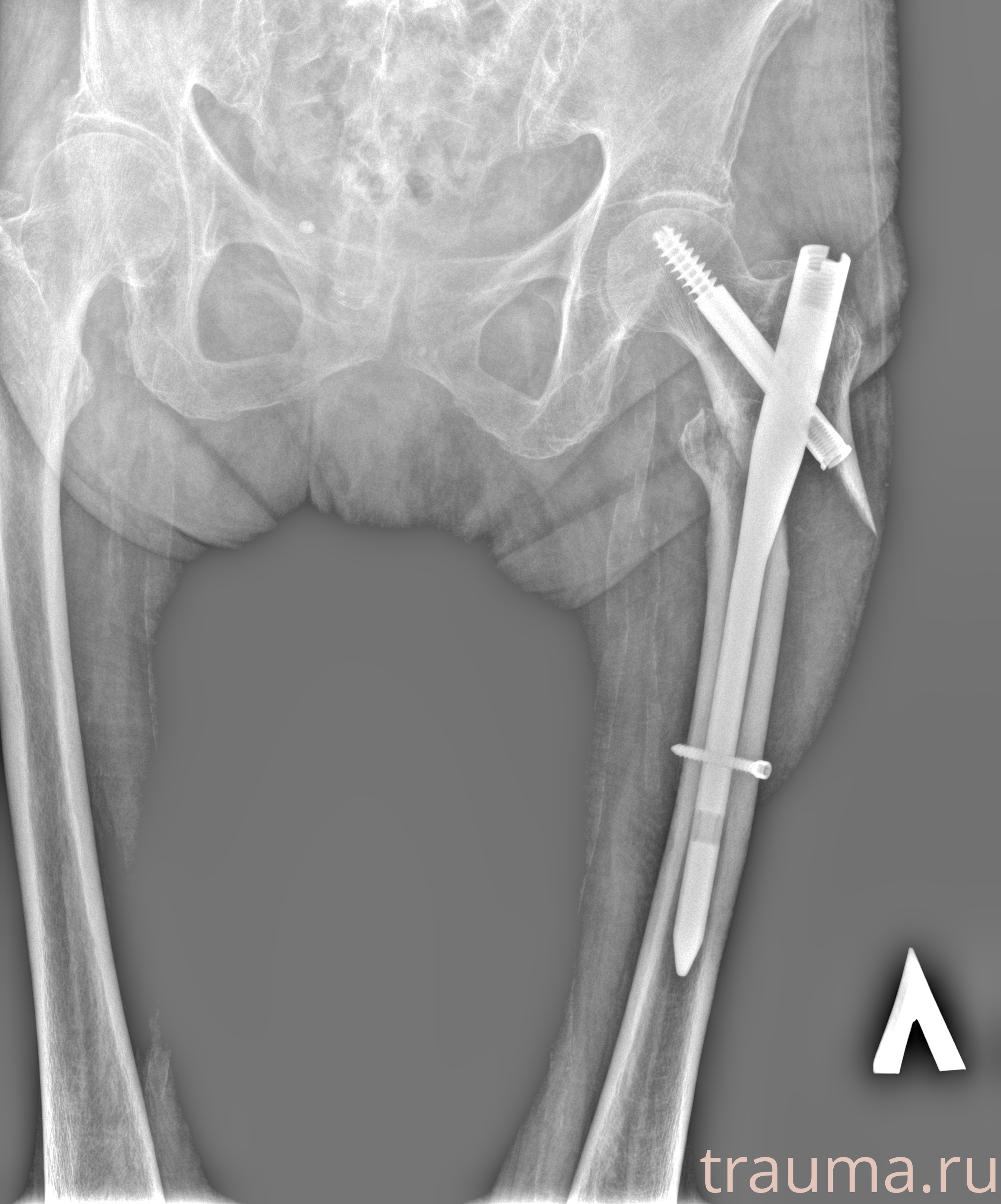 Рентген на дому: по вашему адресу приезжает врач-рентгенолог, травматолог-ортопед с мобильным рентгеновским аппаратом, проводит диагностику травмы или заболевания, делает необходимые рентгенограммы, дает рекомендации по дальнейшему лечению. Получить качественные снимки в домашних условиях возможно благодаря уникальной методике, разработанной МосРентген Центром для института  Склифосовского