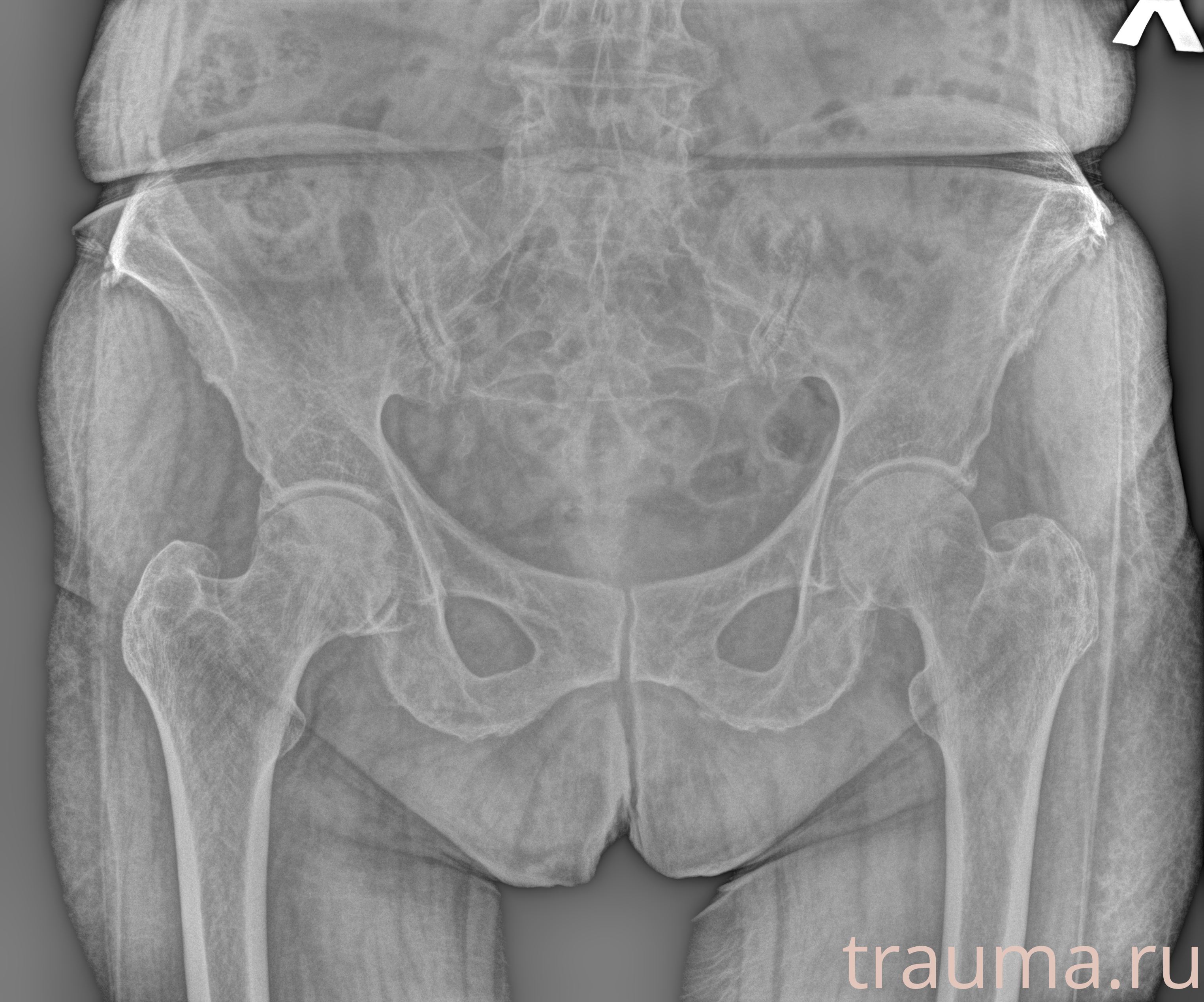 Рентген на дому: по вашему адресу приезжает врач-рентгенолог, травматолог-ортопед с мобильным рентгеновским аппаратом, проводит диагностику травмы или заболевания, делает необходимые рентгенограммы, дает рекомендации по дальнейшему лечению. Получить качественные снимки в домашних условиях возможно благодаря уникальной методике, разработанной МосРентген Центром для института  Склифосовского