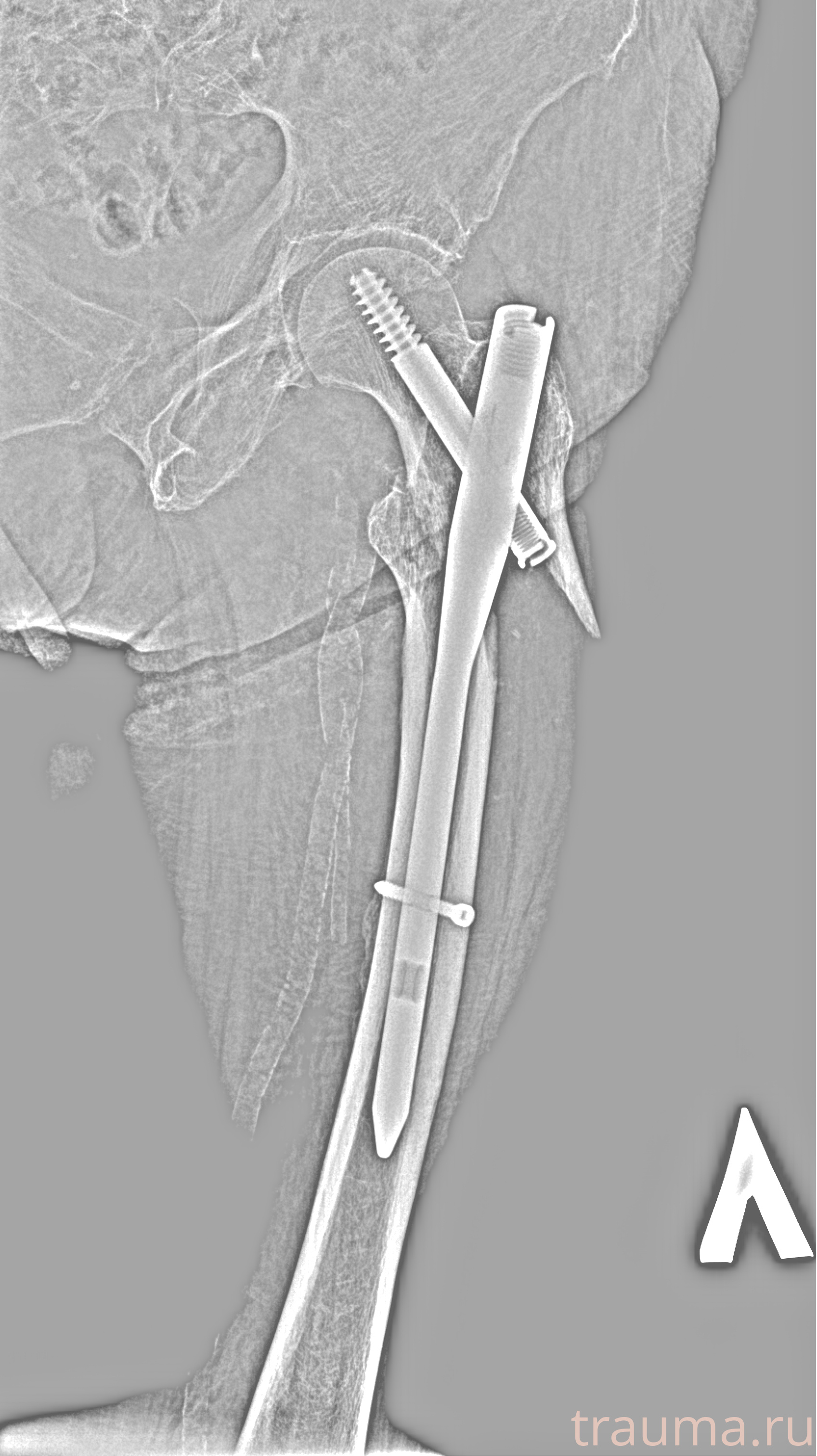 Рентген на дому: по вашему адресу приезжает врач-рентгенолог, травматолог-ортопед с мобильным рентгеновским аппаратом, проводит диагностику травмы или заболевания, делает необходимые рентгенограммы, дает рекомендации по дальнейшему лечению. Получить качественные снимки в домашних условиях возможно благодаря уникальной методике, разработанной МосРентген Центром для института  Склифосовского