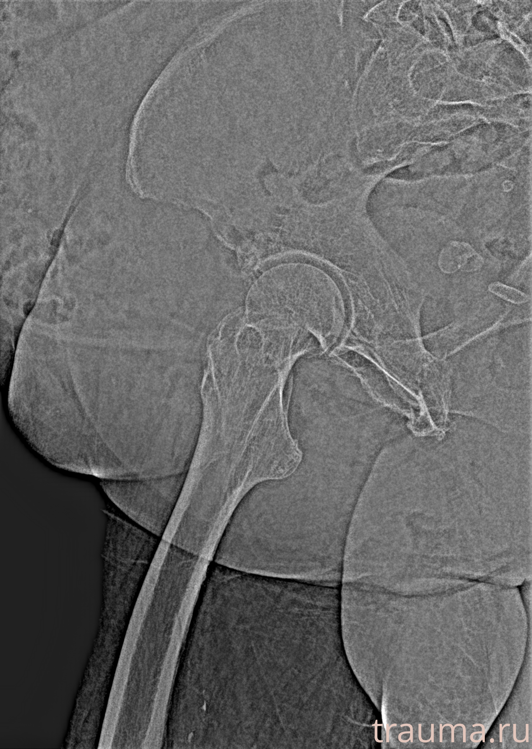 Рентген на дому: по вашему адресу приезжает врач-рентгенолог, травматолог-ортопед с мобильным рентгеновским аппаратом, проводит диагностику травмы или заболевания, делает необходимые рентгенограммы, дает рекомендации по дальнейшему лечению. Получить качественные снимки в домашних условиях возможно благодаря уникальной методике, разработанной МосРентген Центром для института  Склифосовского