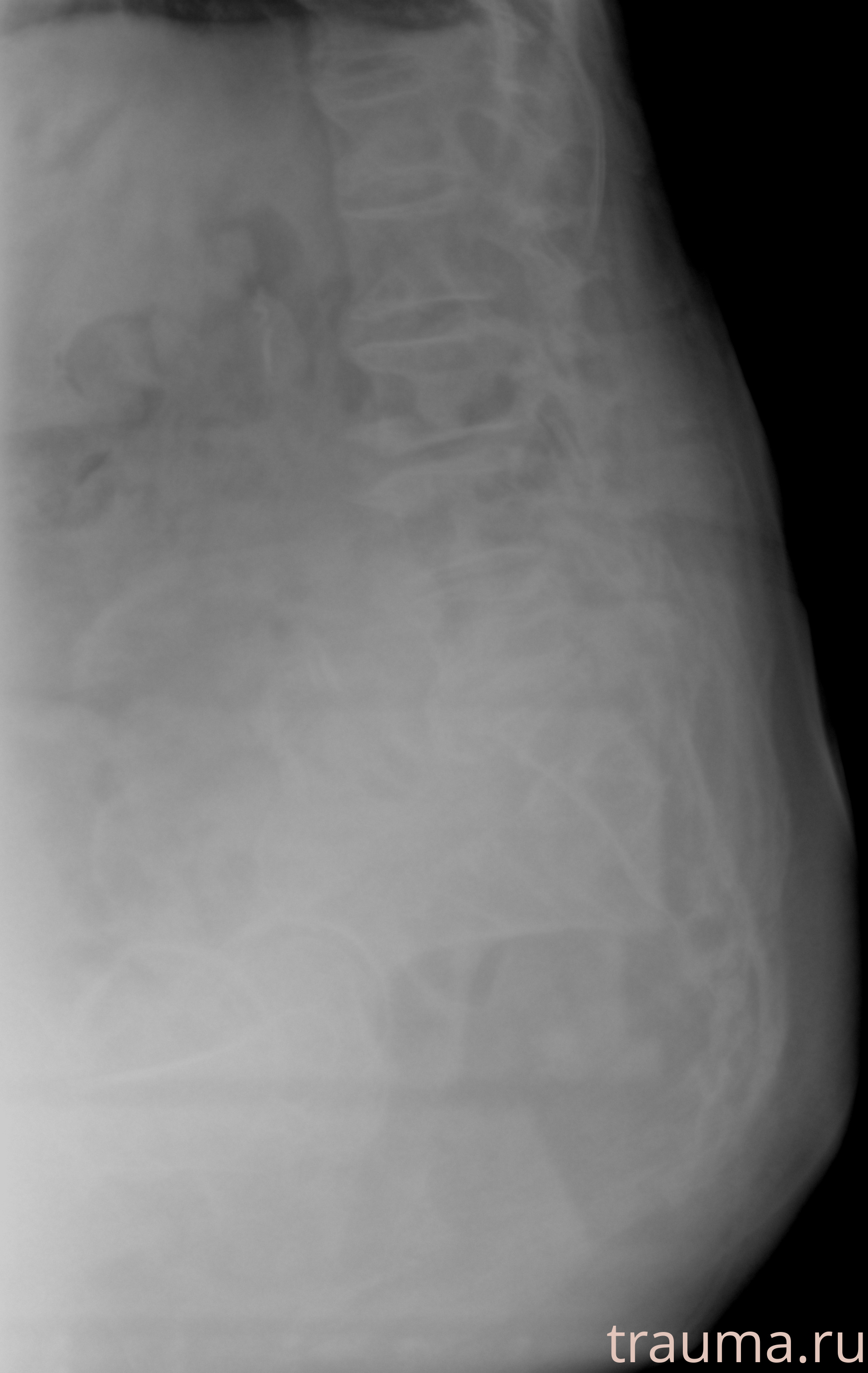 Рентген на дому: по вашему адресу приезжает врач-рентгенолог, травматолог-ортопед с мобильным рентгеновским аппаратом, проводит диагностику травмы или заболевания, делает необходимые рентгенограммы, дает рекомендации по дальнейшему лечению. Получить качественные снимки в домашних условиях возможно благодаря уникальной методике, разработанной МосРентген Центром для института  Склифосовского