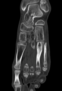 МСКТ-семиотика спицевого остеомиелита