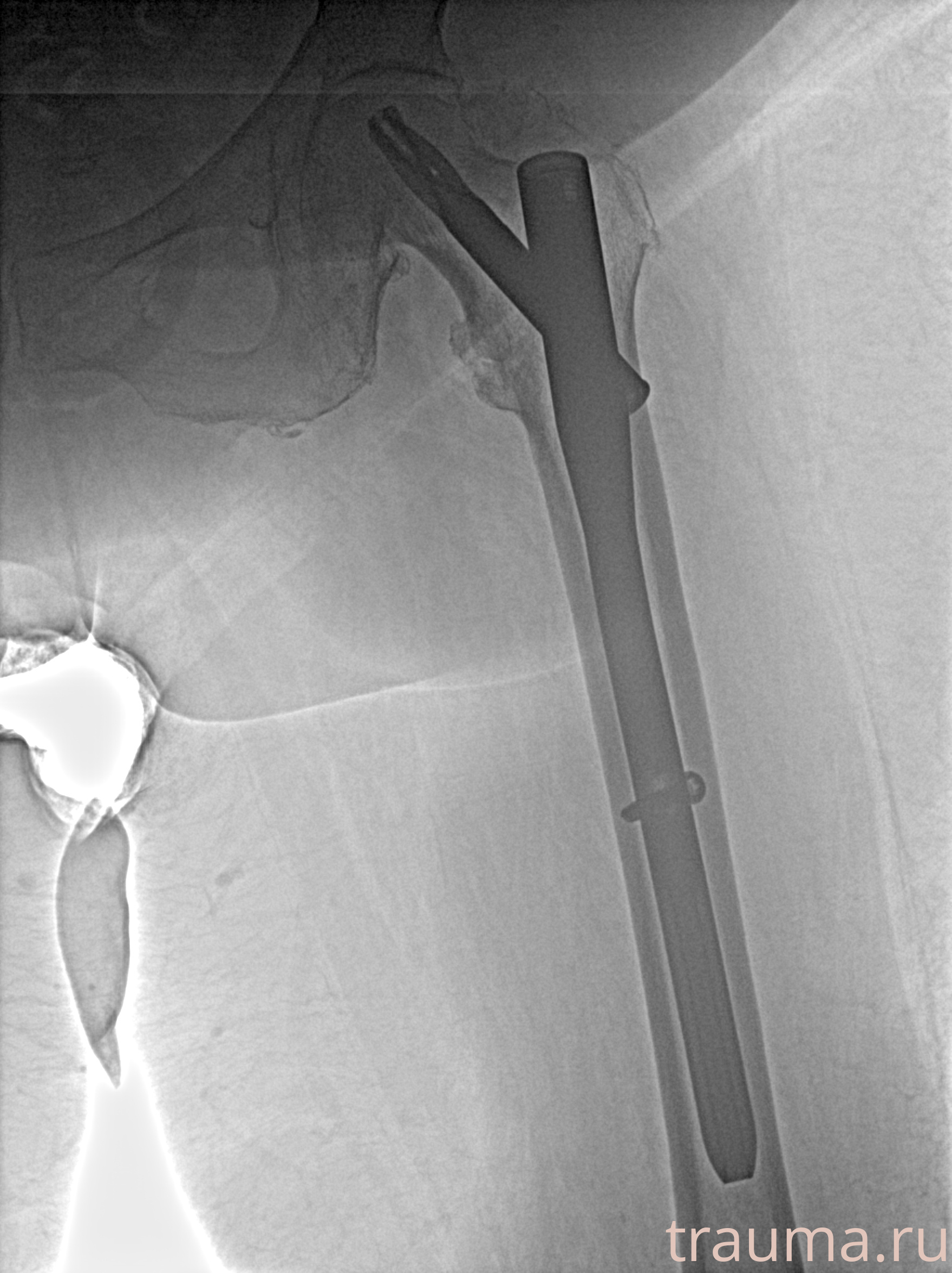 Рентген на дому: по вашему адресу приезжает врач-рентгенолог, травматолог-ортопед с мобильным рентгеновским аппаратом, проводит диагностику травмы или заболевания, делает необходимые рентгенограммы, дает рекомендации по дальнейшему лечению. Получить качественные снимки в домашних условиях возможно благодаря уникальной методике, разработанной МосРентген Центром для института  Склифосовского