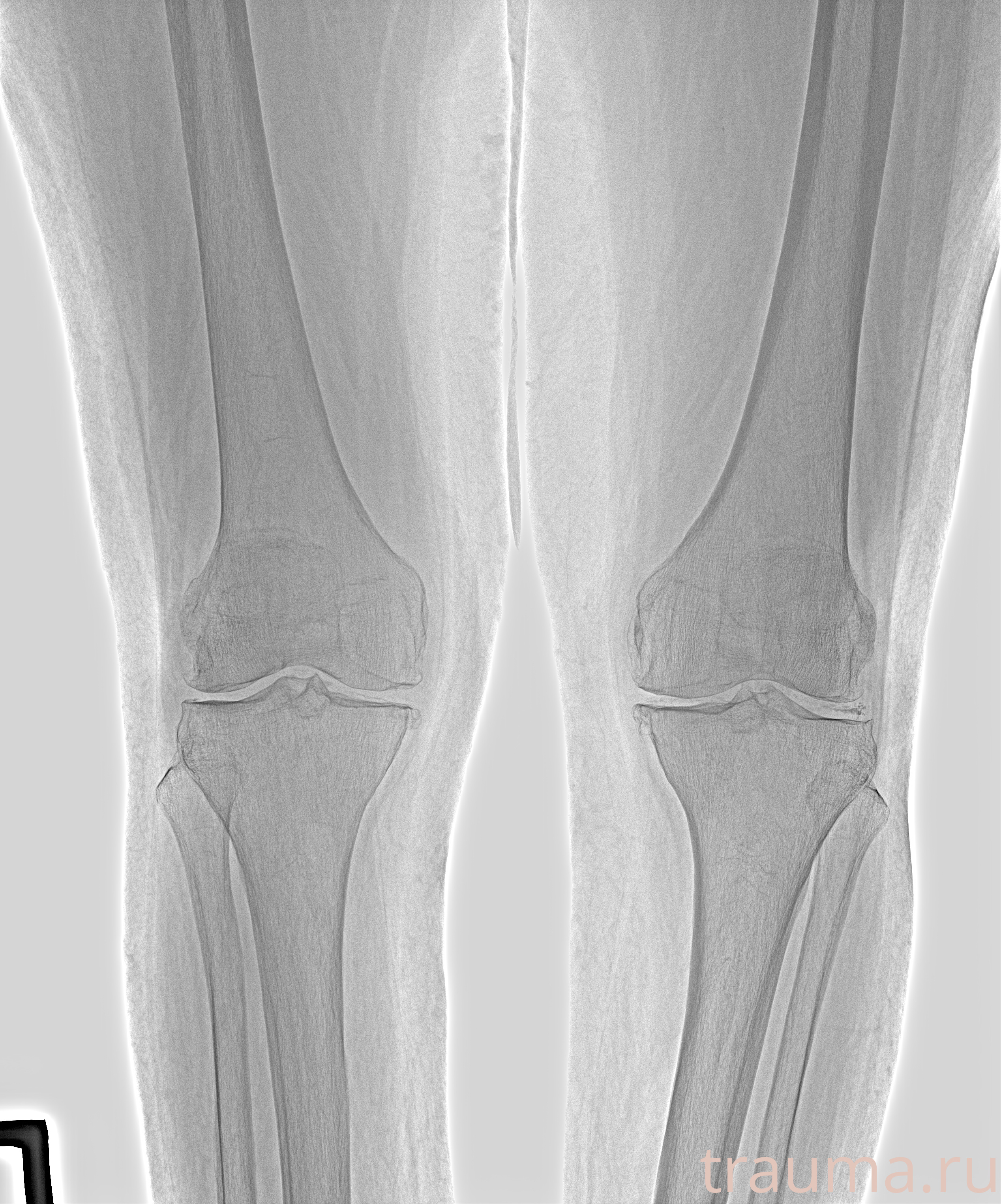 Рентген на дому: по вашему адресу приезжает врач-рентгенолог, травматолог-ортопед с мобильным рентгеновским аппаратом, проводит диагностику травмы или заболевания, делает необходимые рентгенограммы, дает рекомендации по дальнейшему лечению. Получить качественные снимки в домашних условиях возможно благодаря уникальной методике, разработанной МосРентген Центром для института  Склифосовского